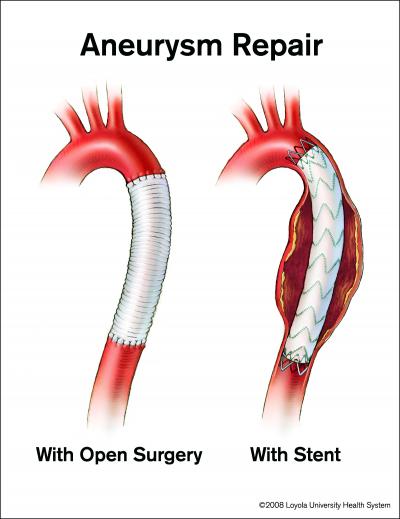 More Aortic Chest Aneurysms Being Treated With Less Invasive Stents