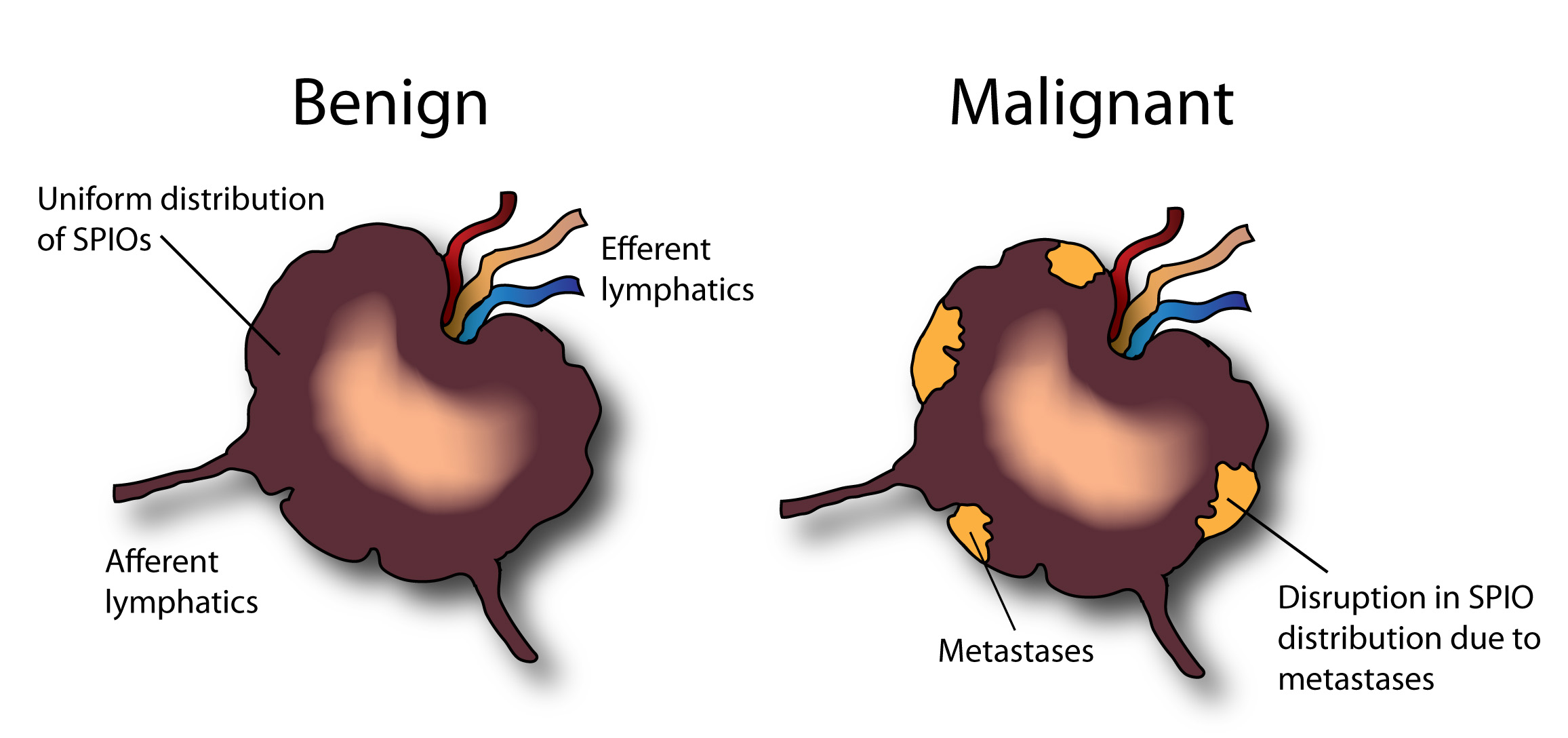Метастатические лимфоузлы. Метастаз меланомы в лимфоузел. Метастатические опухоли лимфатического узла. Метастаз меланомы в лимфатический узел. Раковые клетки в лимфоузлах.