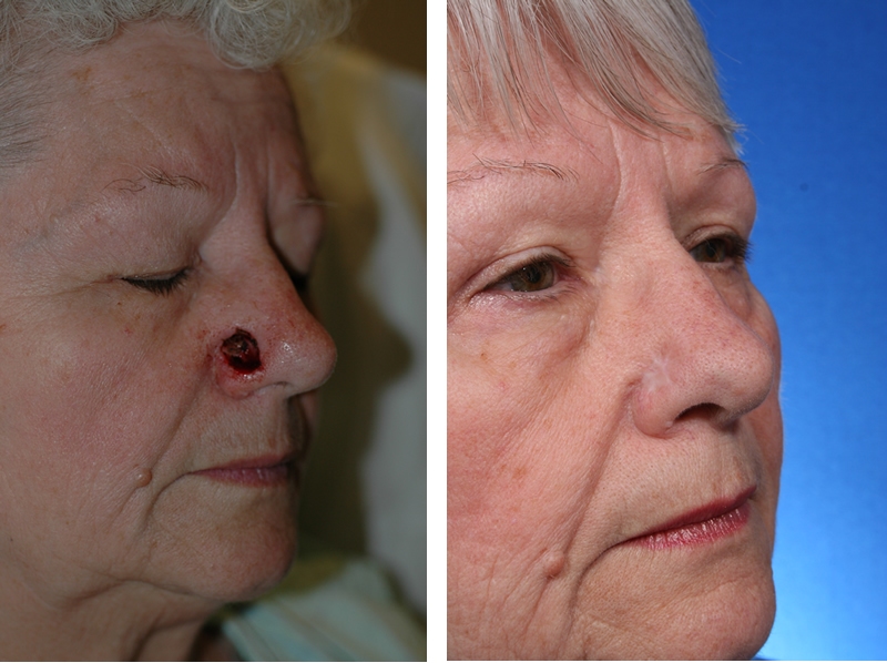 Repairing The Nose After Skin Cancer In Just One Step