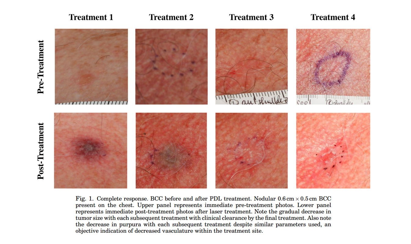 Stages Of Basal Cell Carcinoma Skin Cancer Types Of M - vrogue.co