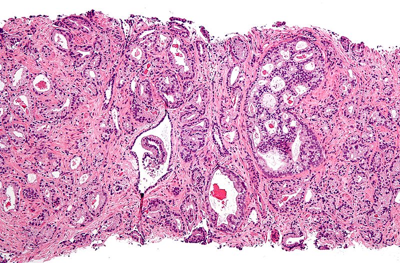 Testicular cancer vascular invasion - Carcinom varicoasă