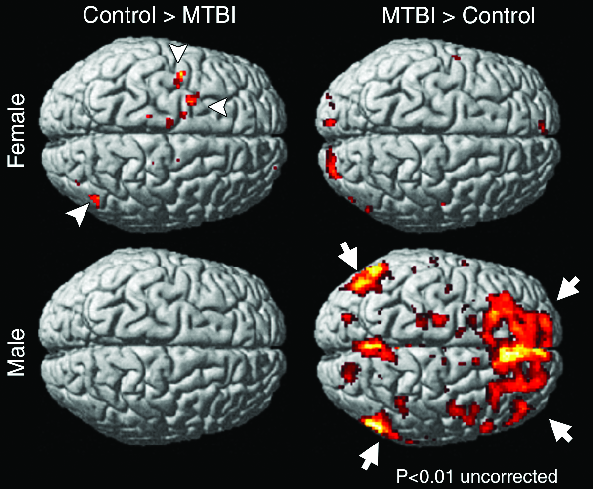 Is Concussion Associated with Abnormal Menstrual Patterns in Young Women? -  Neuroscience News