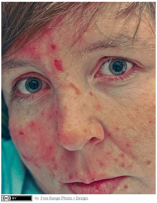 Test compulsive skin picking Dermatillomania: meet
