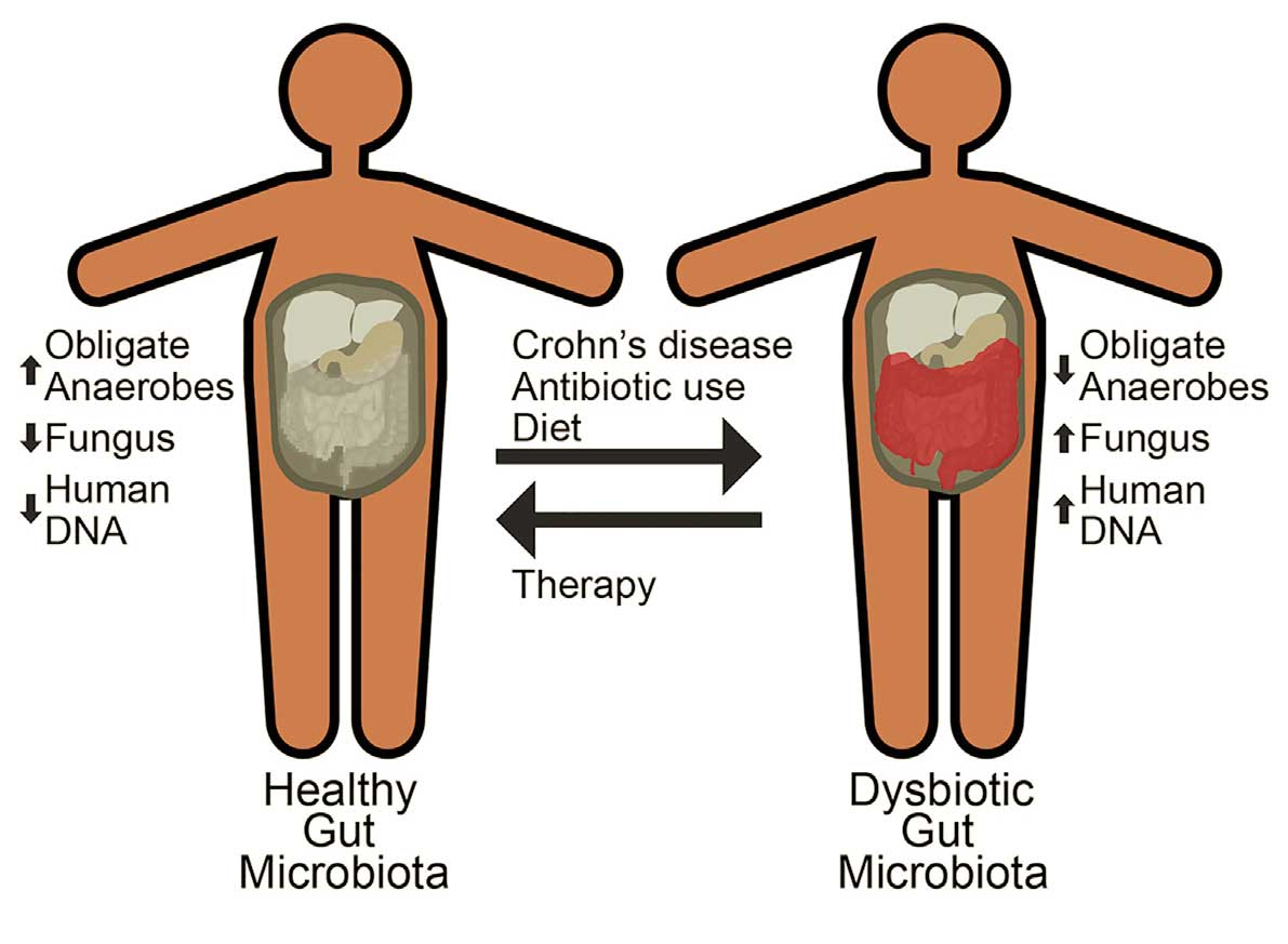 Individualised Care for Crohn's Disease: Evolving Approaches for a  Progressive Disease - European Medical Journal