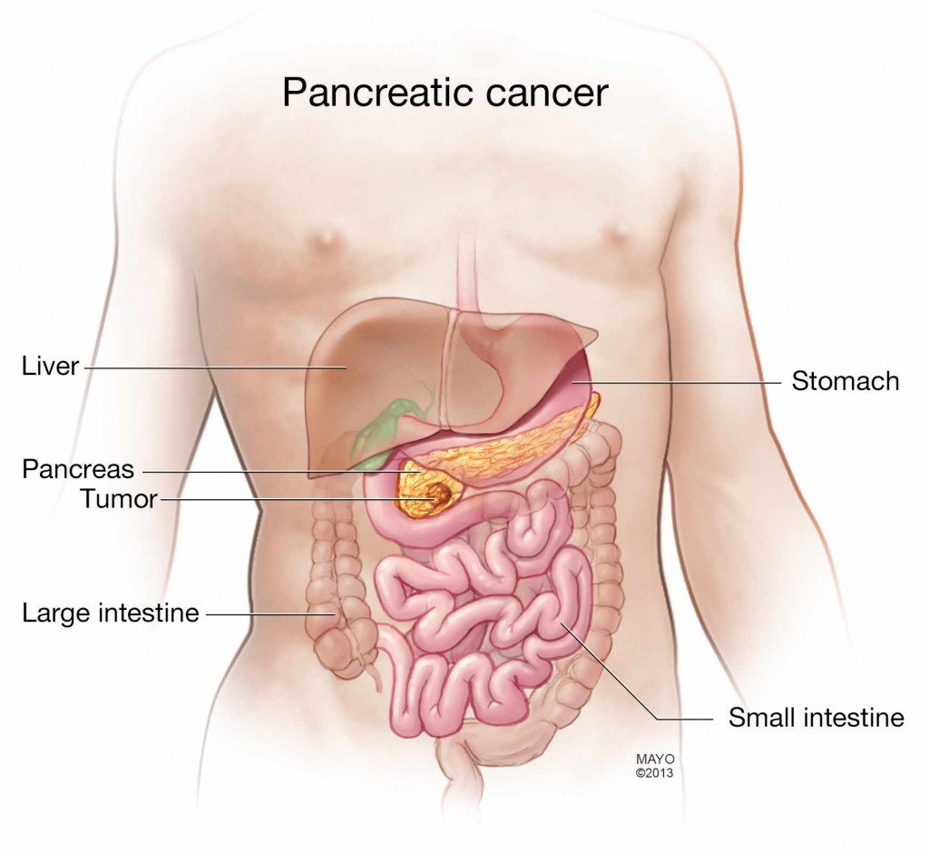 Pancreatic cancer news. Pancreatic cancer end of life Bucharest PancreaticFest – September ,