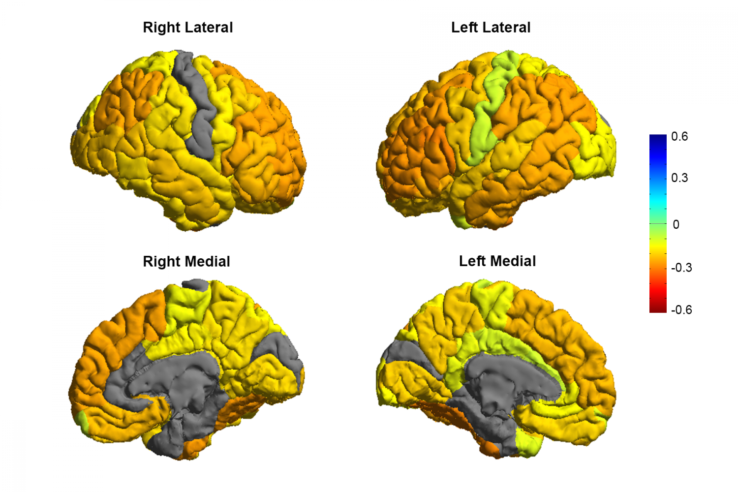 Депрессия головного мозга. Мозг человека с биполярным расстройством. Мозг при биполярном расстройстве. Активность мозга при биполярном расстройстве.