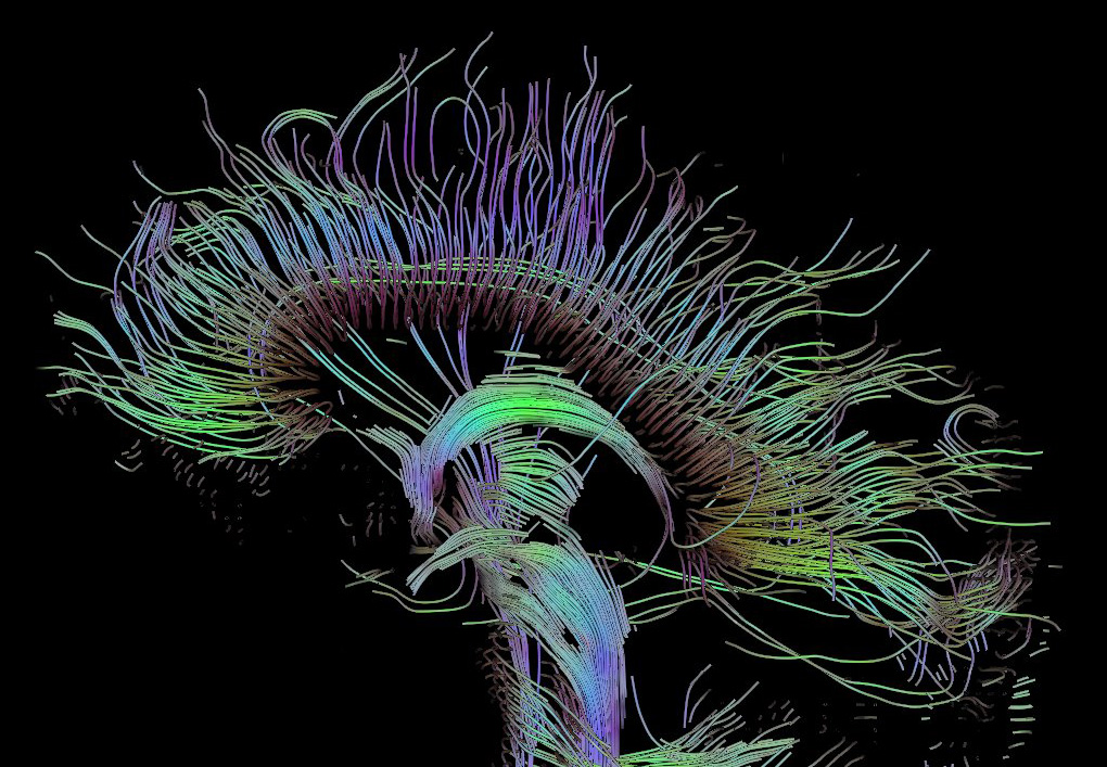 Brain imaging Reveals Why Some People Are More Creative Than Others