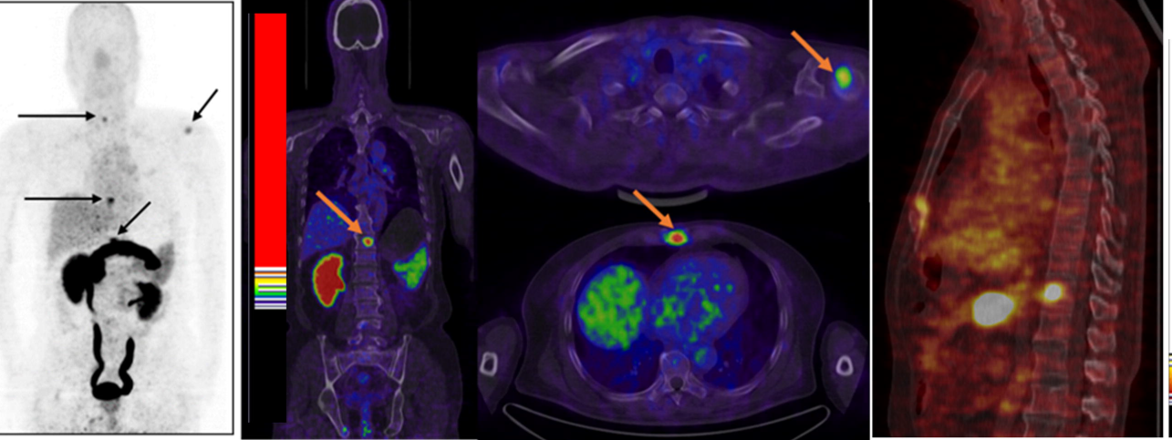Позитронно эмиссионная томография почек. Позитронно-эмиссионная томография метастазы. Позитрон-эмиссионная  томография: ПЭТ. ПЭТ/кт с туморотропными РФП (18f-фтордезоксиглюкоза). Кровь после кт
