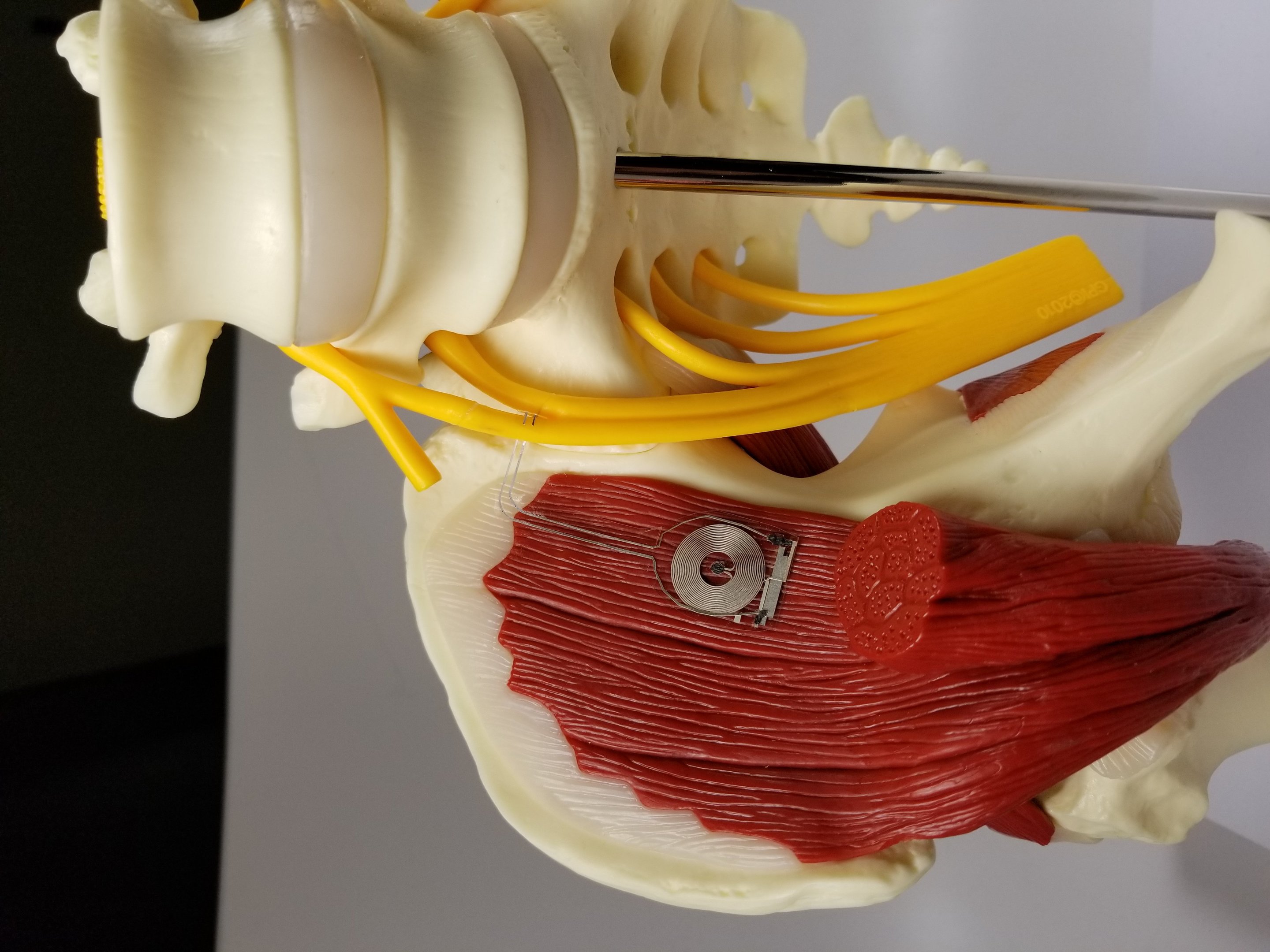 Newly invented electrical stimulation (ES) device improves nerve  regeneration in humans