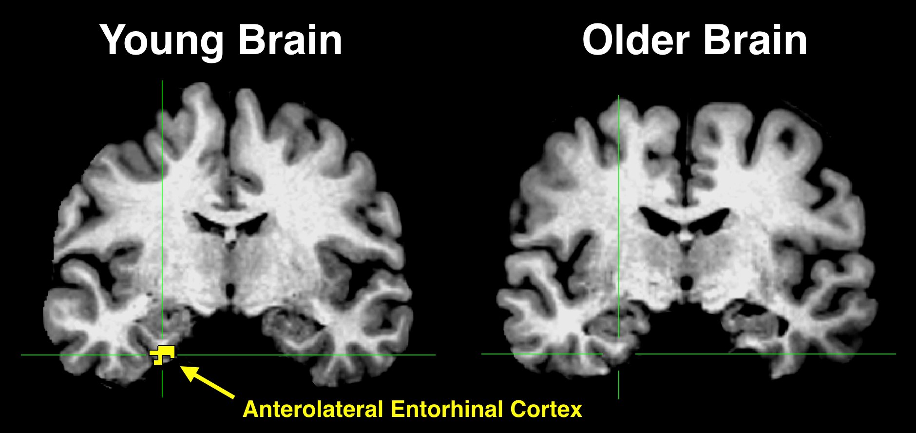 Brain old. Мозг молодого и старого. Мозг молодого и пожилого. Мозг молодого и старого человека. Мозг молодого человека и мозг старого человека.