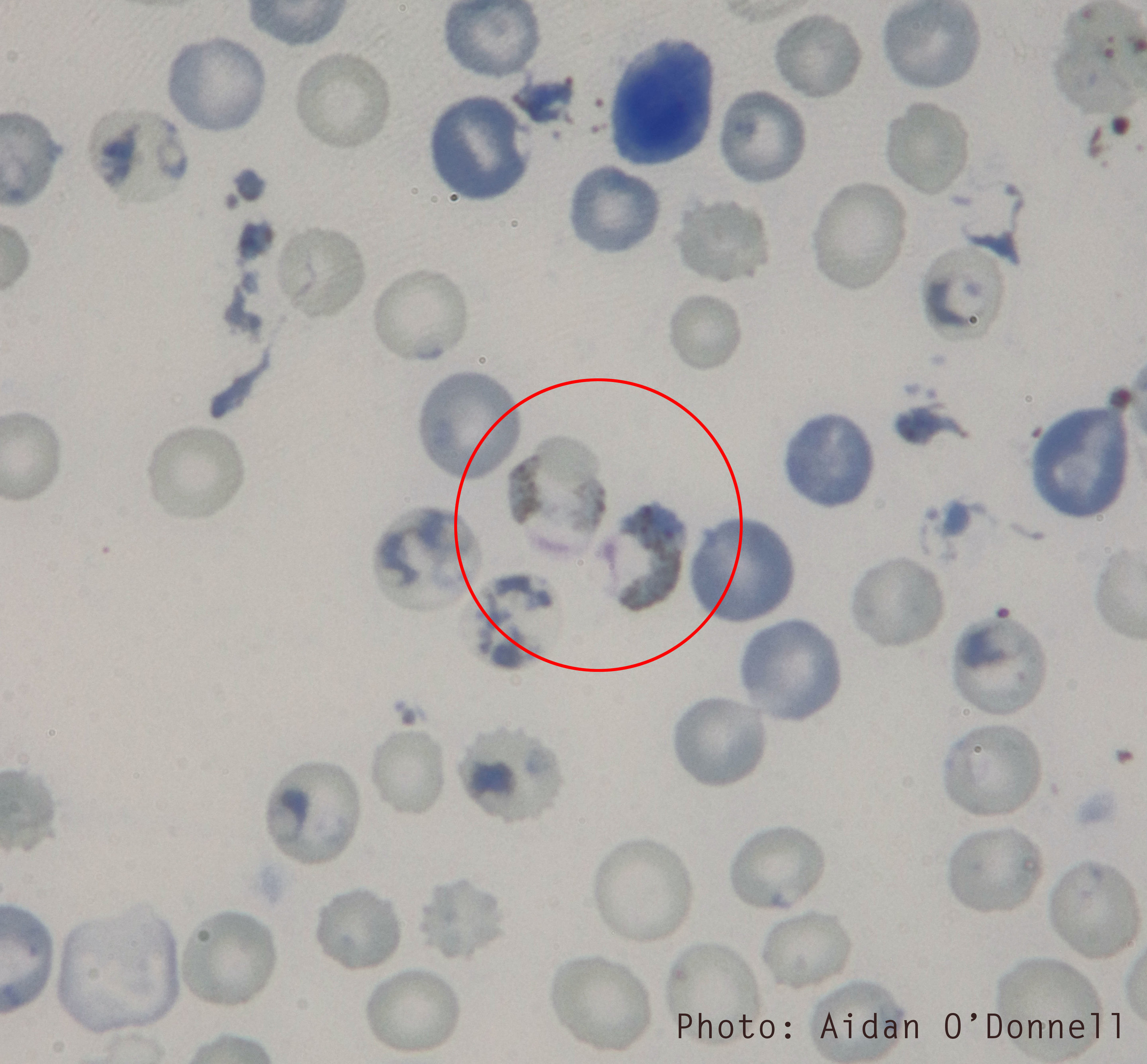 Кровь на малярию. Плазмодии малярии в толстой капле крови. Малярия мазок крови микроскопия. Plasmodium malariae микроскопия. Малярийный плазмодий микроскопия.
