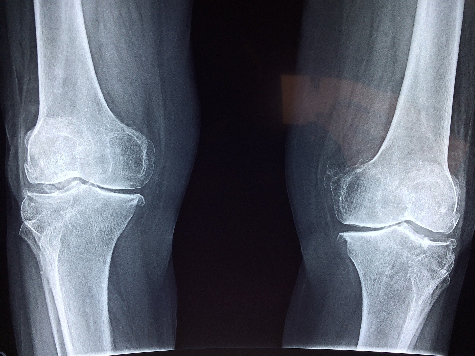 osteoarthritis and low carb diet