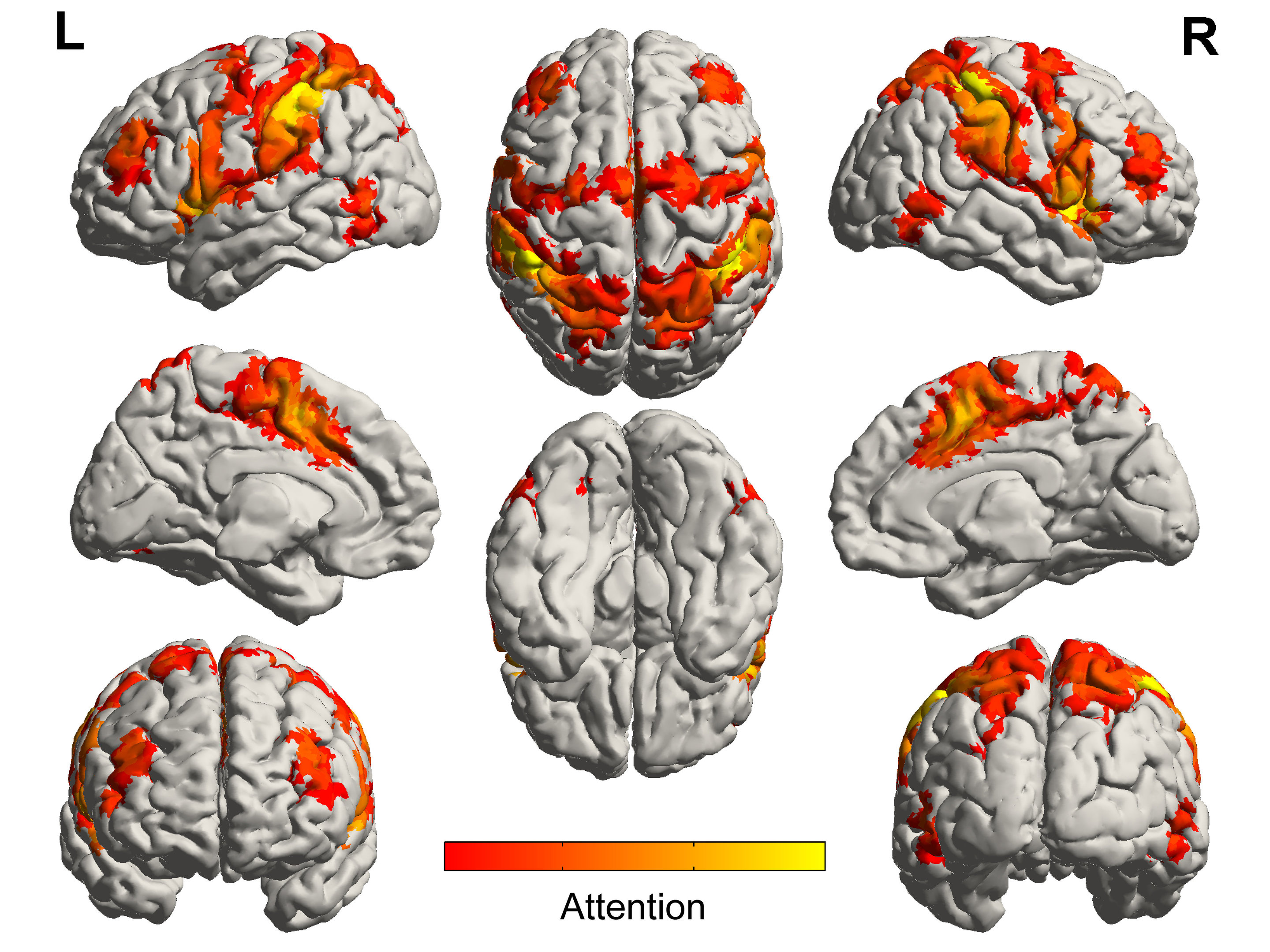 Music activates regions of the brain spared by Alzheimer's disease