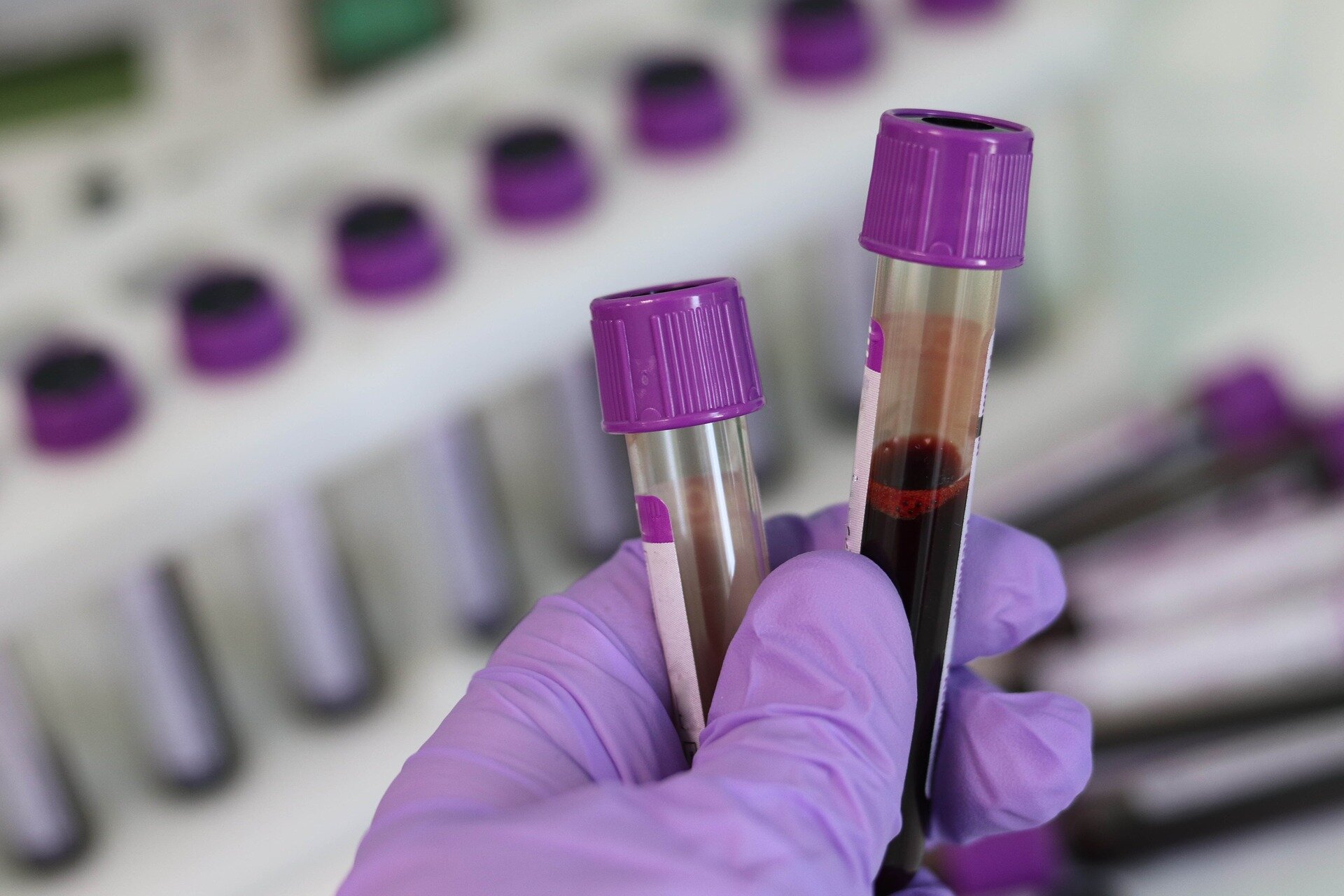 #Blood-based markers may reveal Alzheimer’s disease ten years before symptoms show
