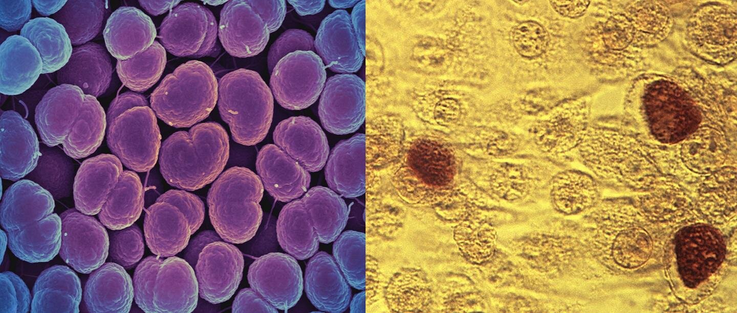 Chlamydia trachomatis neisseria gonorrhoeae. Хламидия под микроскопом. Хламидия 3 д модель.