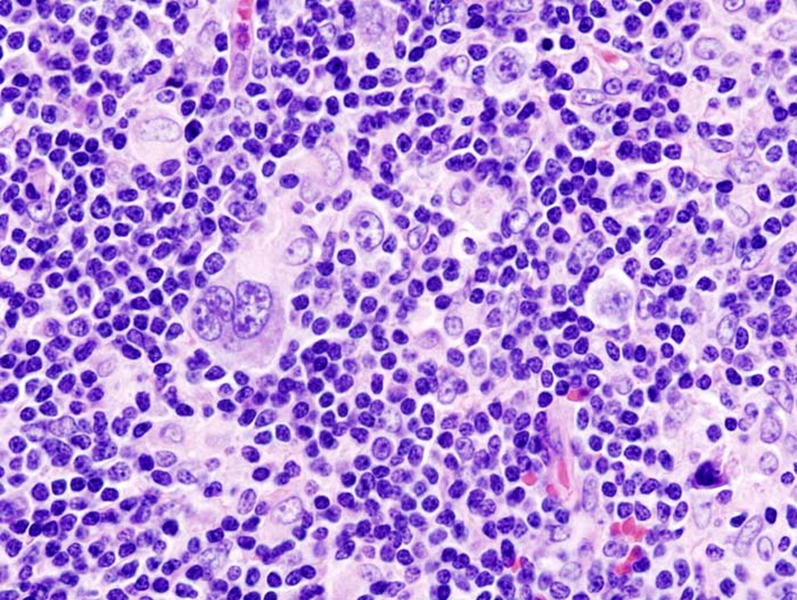 Why Hodgkins Lymphoma Cells Grow Uncontrollably