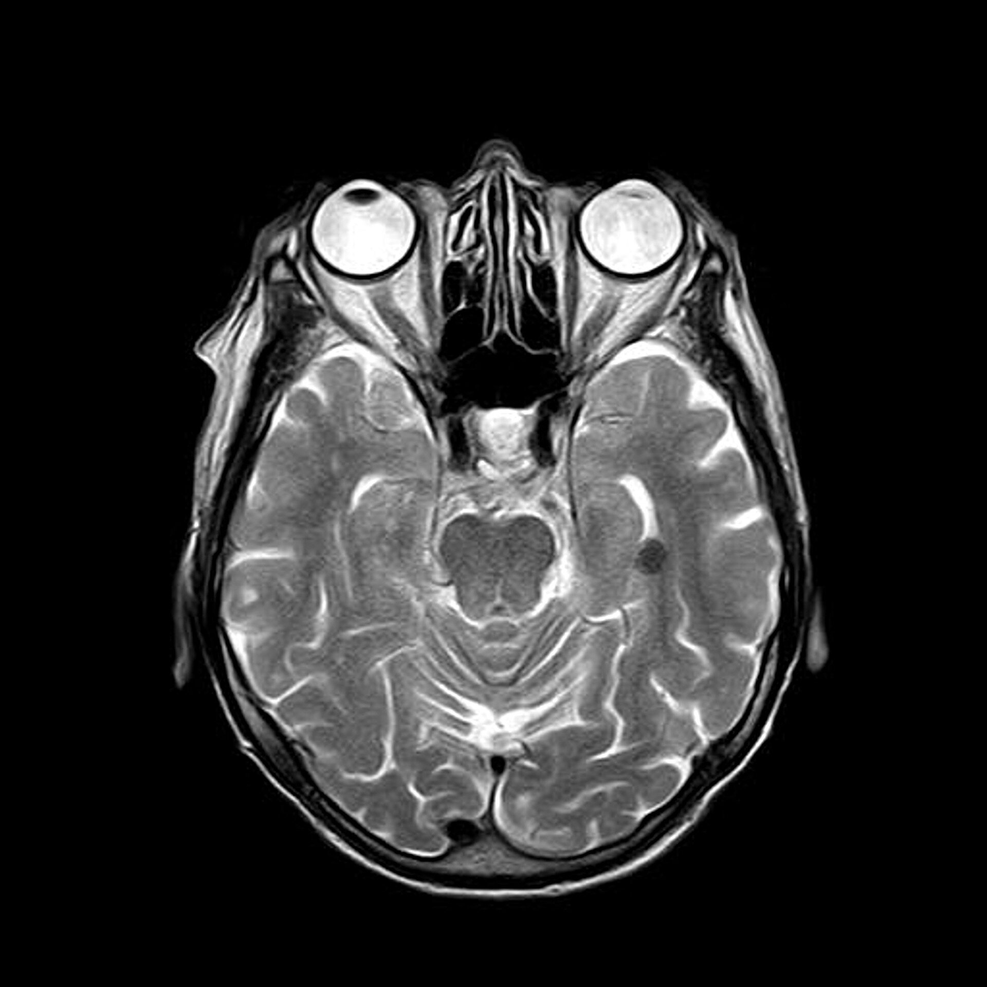New MRI Technique Can Detect Early Dysfunction Of The Blood Brain Barrier With Small Vessel Disease