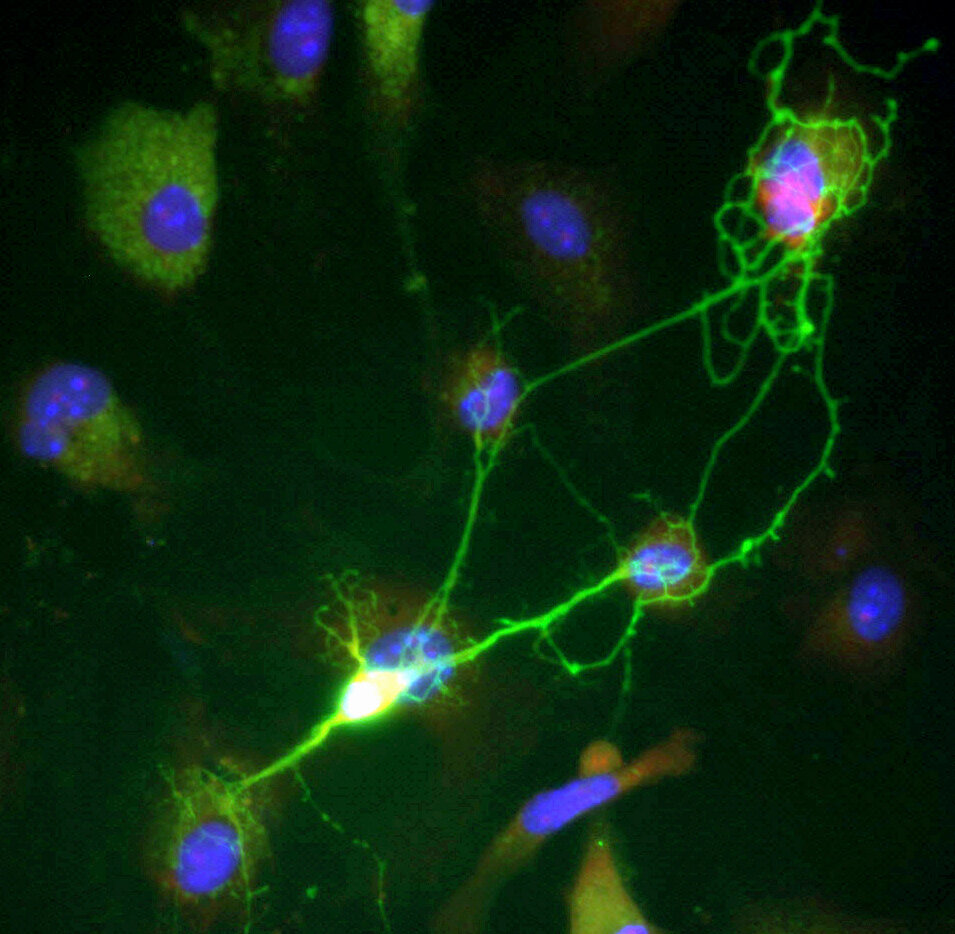 New gene implicated in neuron diseases