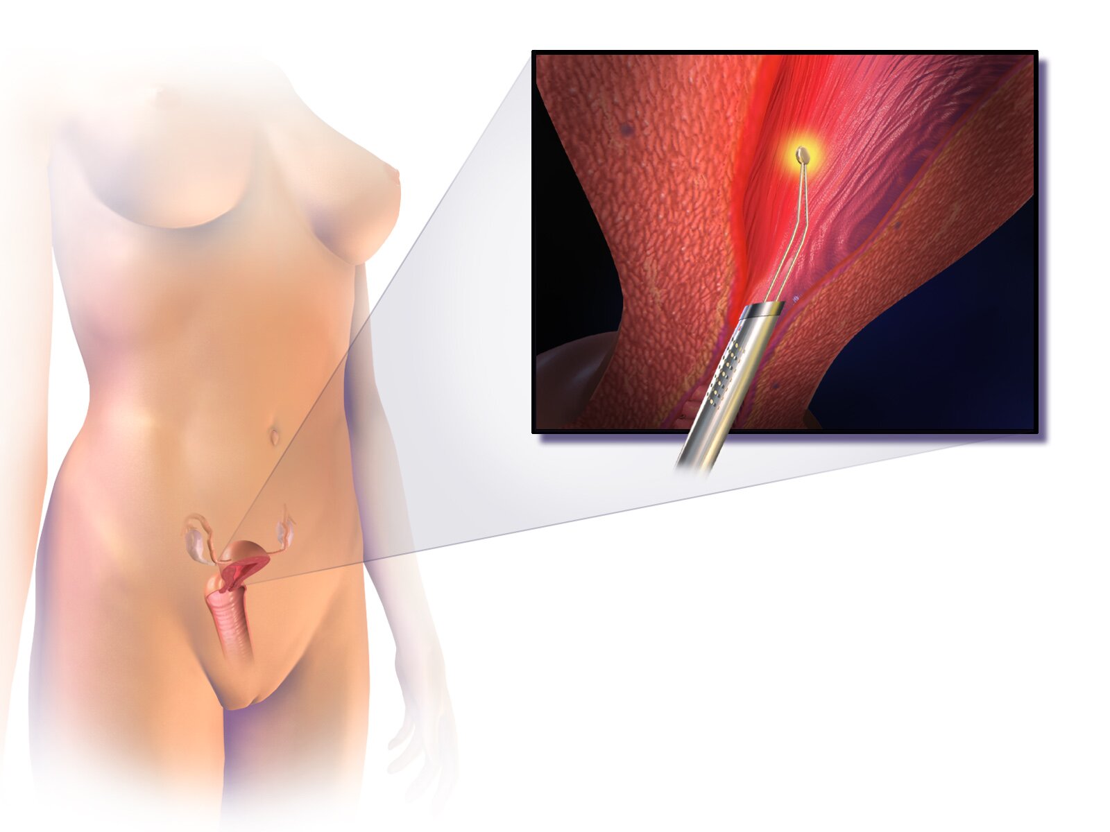 Mayo Clinic Q and A: Endometrial ablation when pelvic pain or