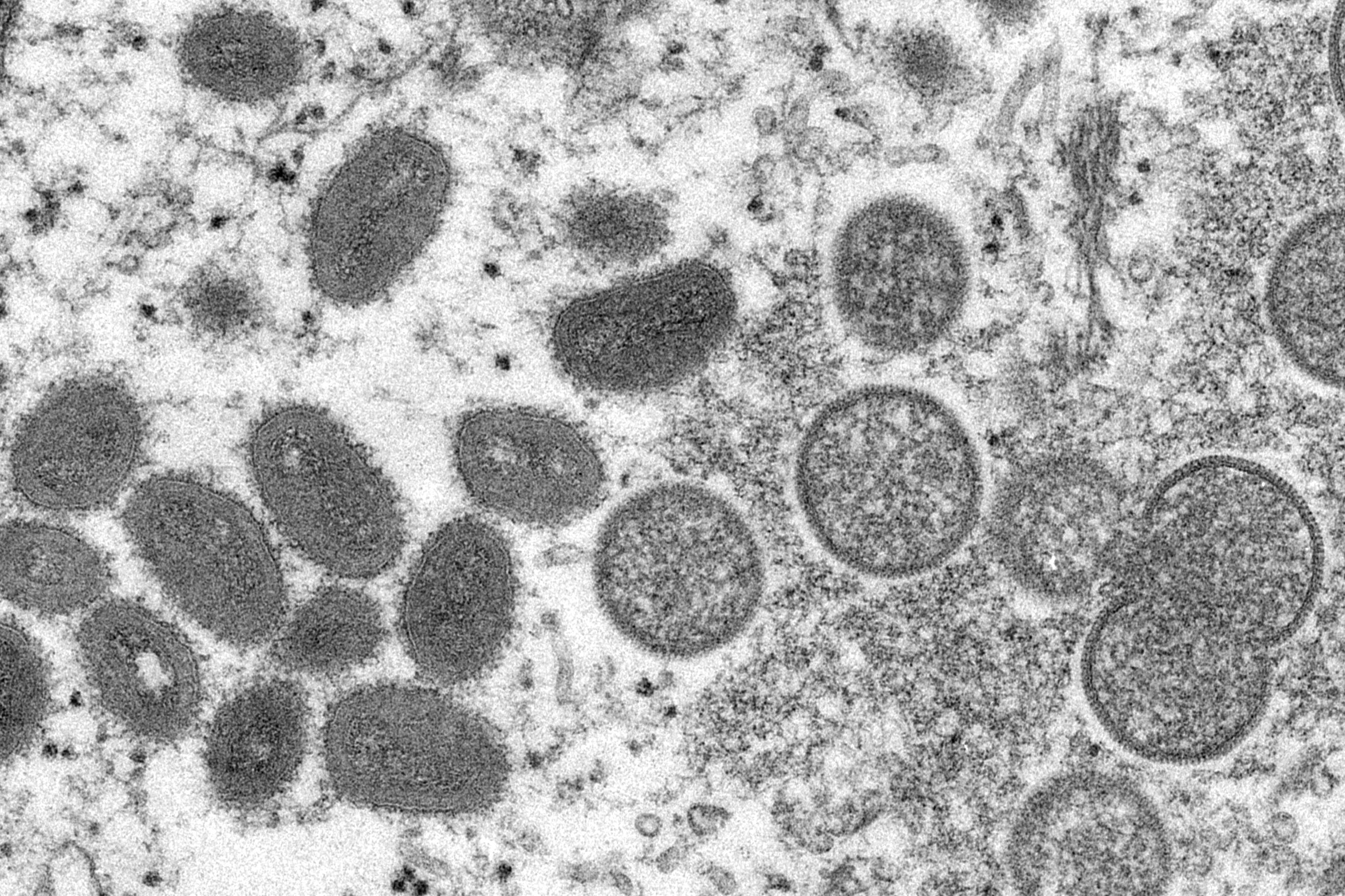 #2 monkeypox strains in US suggest possible undetected spread