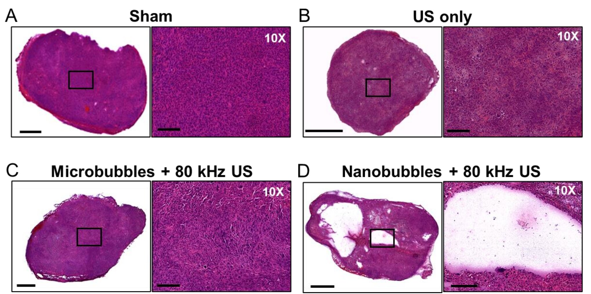 A combination of ultrasound and nanobubbles allows cancerous tumors to be destro..