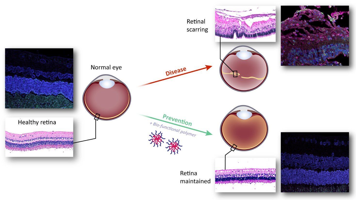 #A novel therapy using unique thermogel prevents retinal scarring