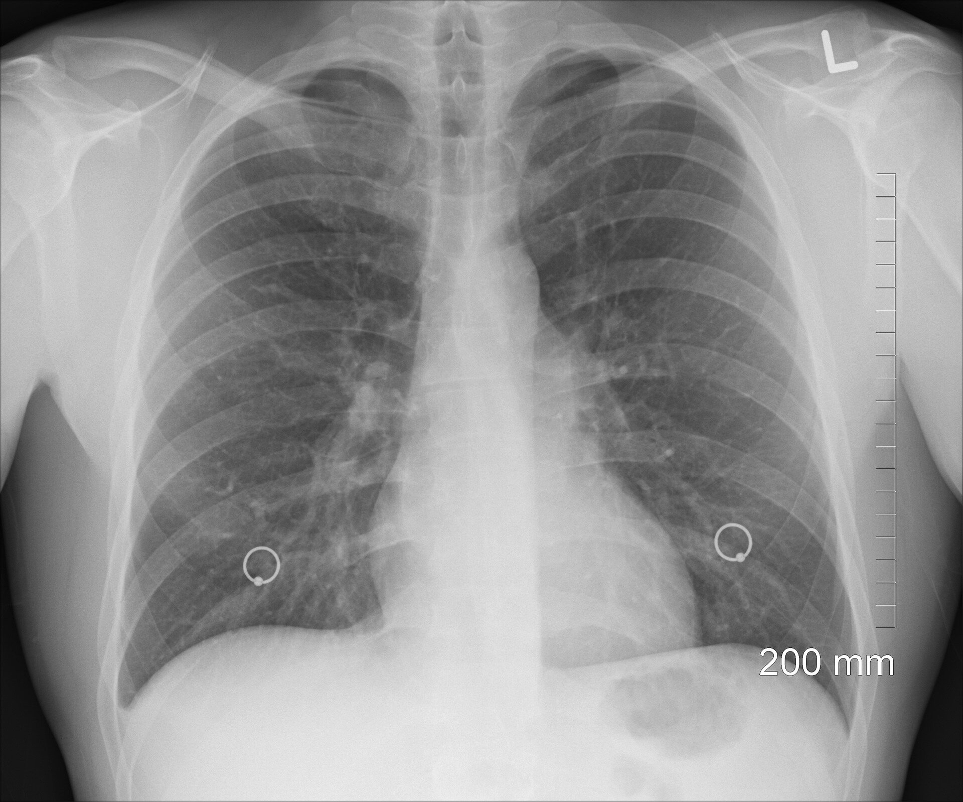 #Severe lung infection during COVID-19 can cause damage to the heart