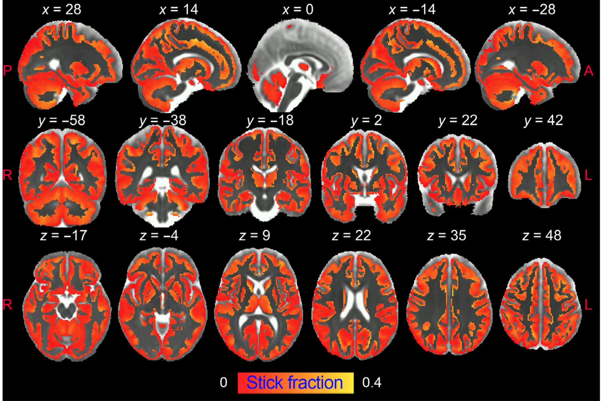 #Magnetic resonance imaging shows brain inflammation in vivo for the first time