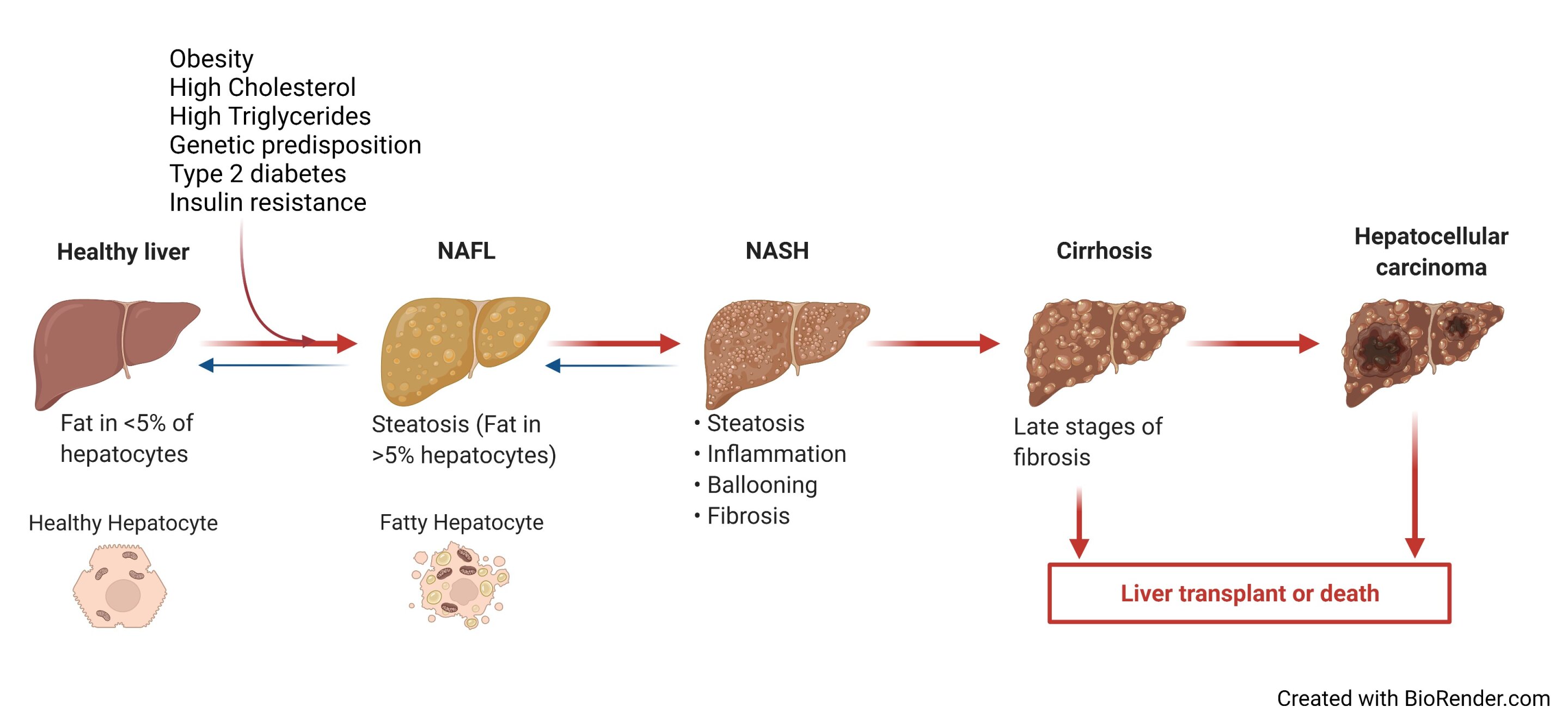 NAFLD & NASH as a metabolic disease