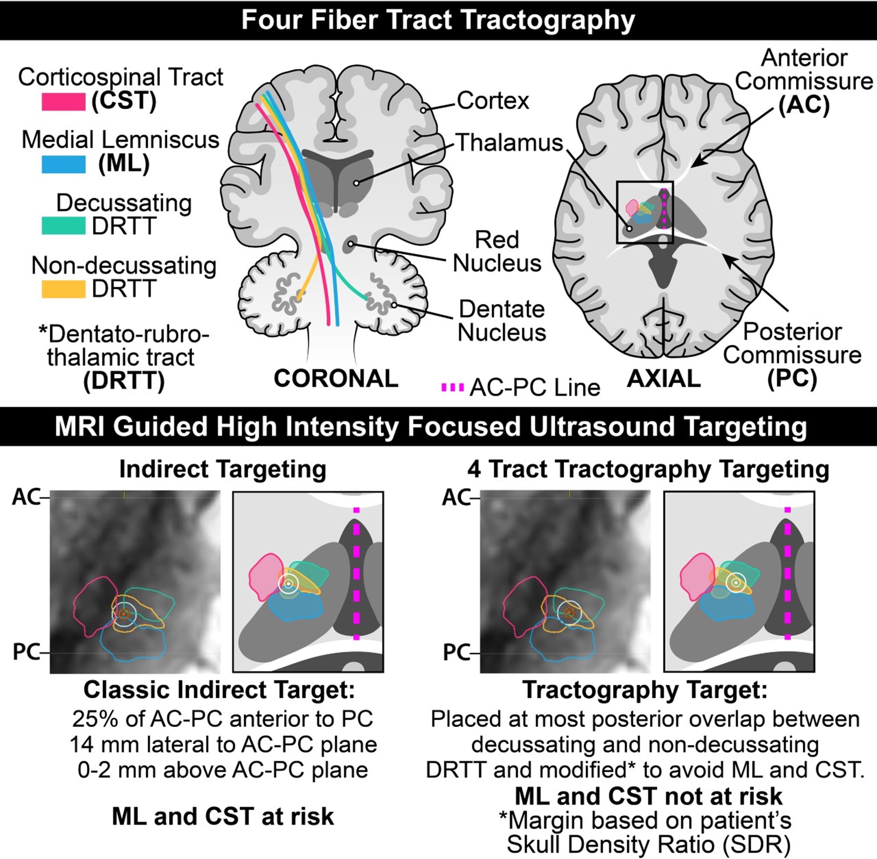 #New technique improves high-intensity focused ultrasound treatment for brain disorders
