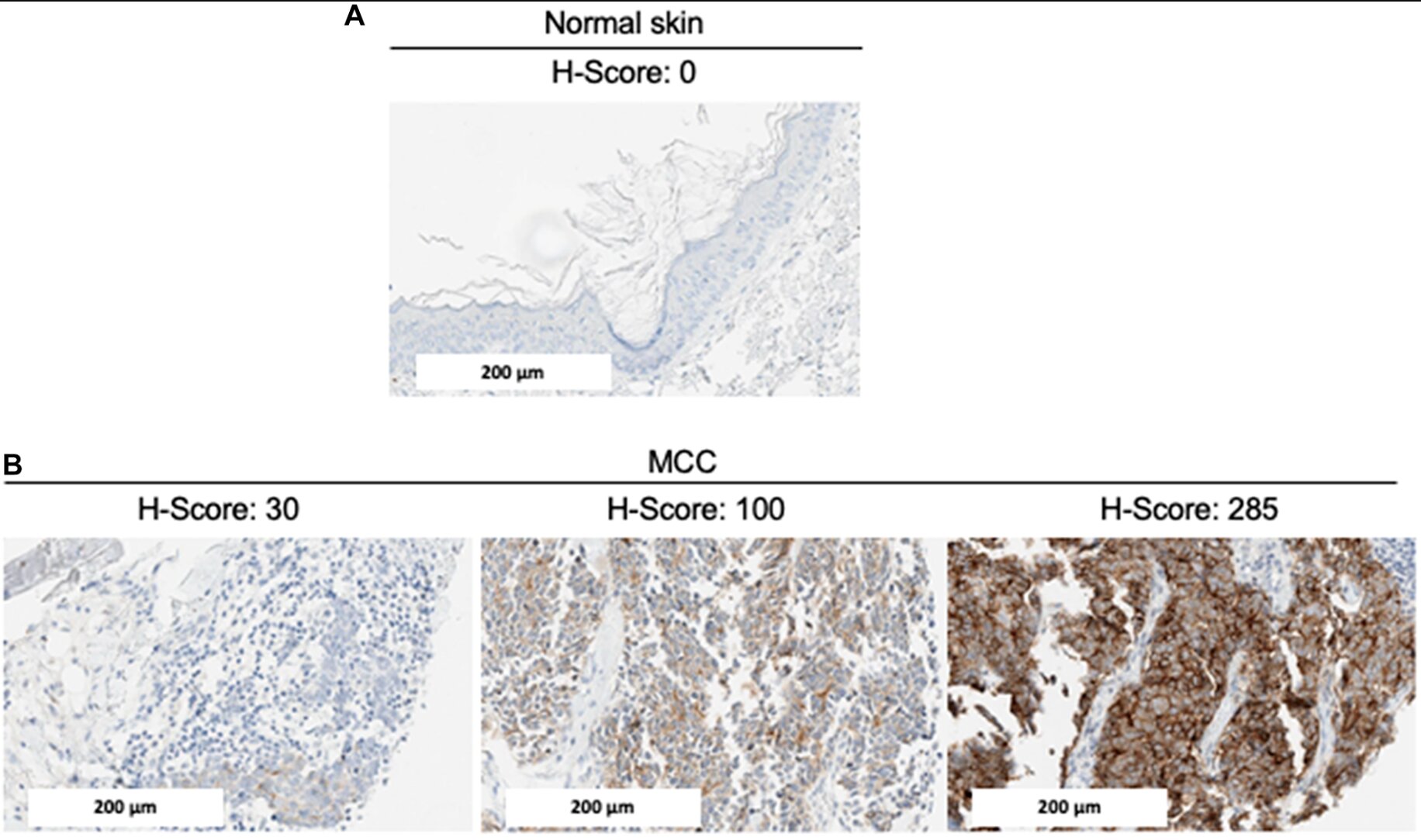 Glypican-3 (GPC3) is associated with MCPyV-negative status and impaired outcome in Merkel cell carcinoma