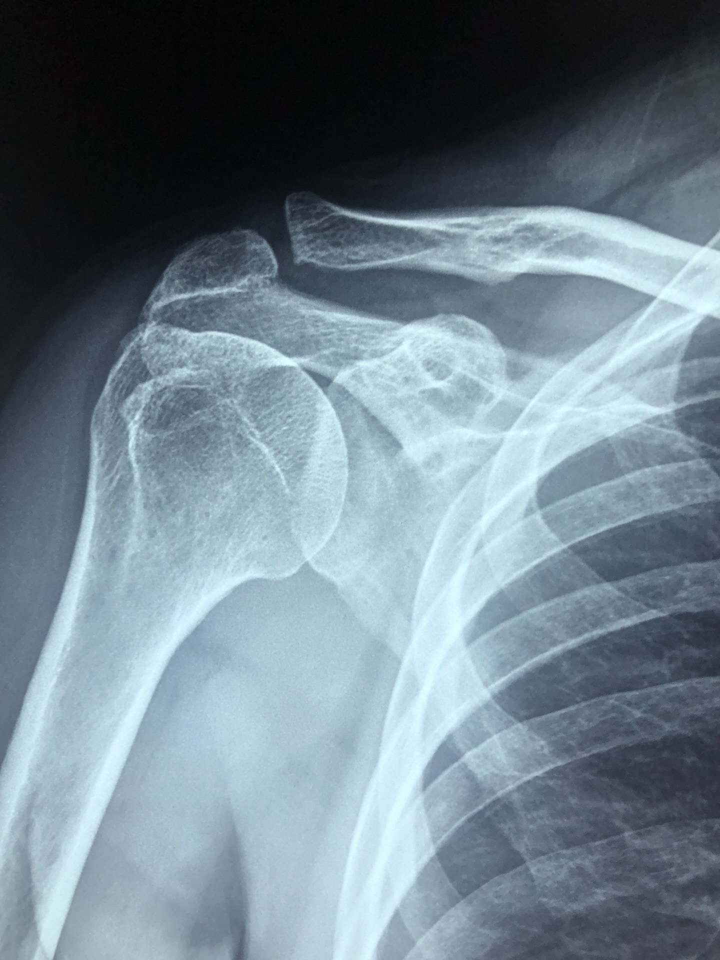 Shoulder replacement surgery - Mayo Clinic