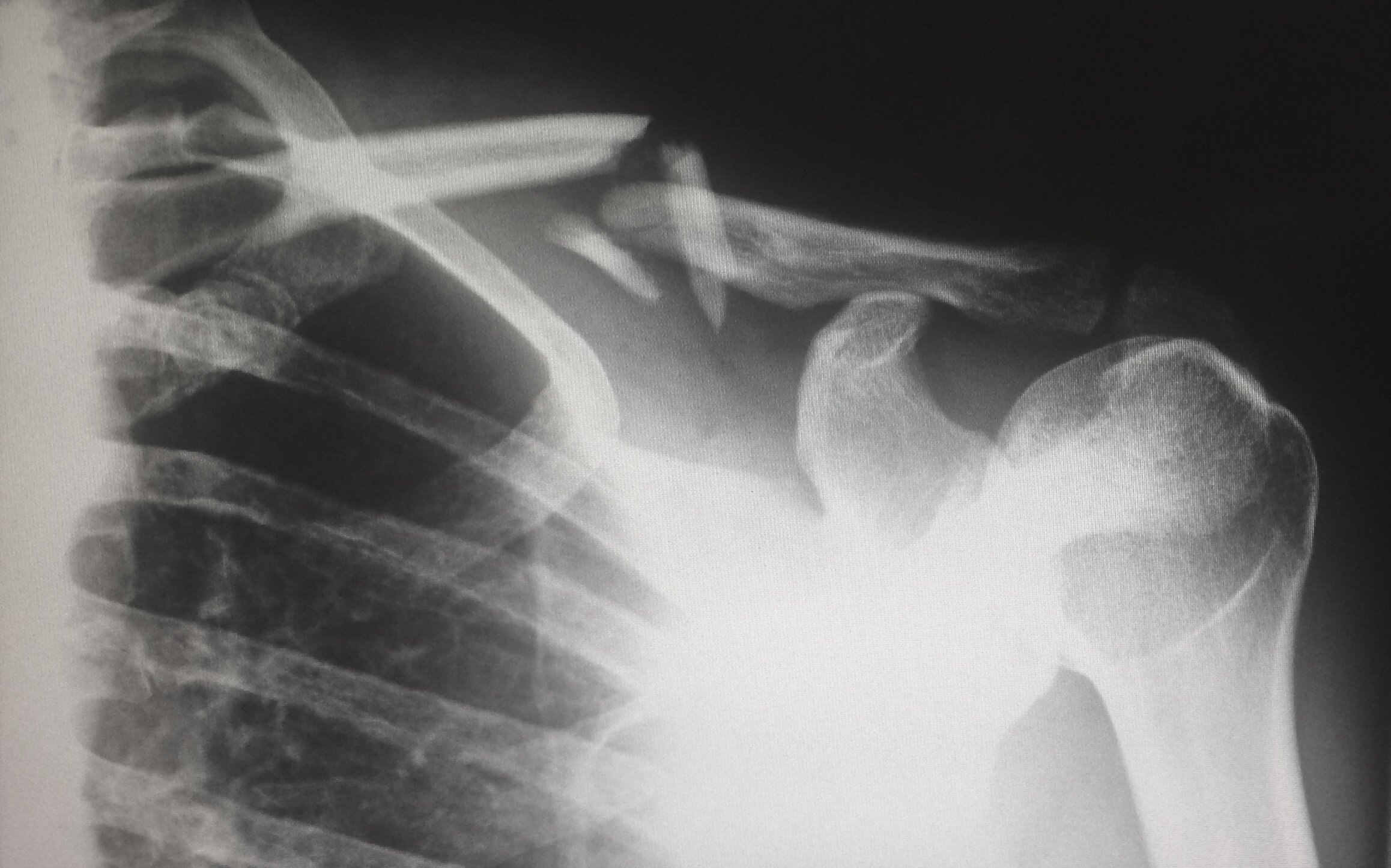 #How orthopedic surgeons fix your shoulder when it’s injured