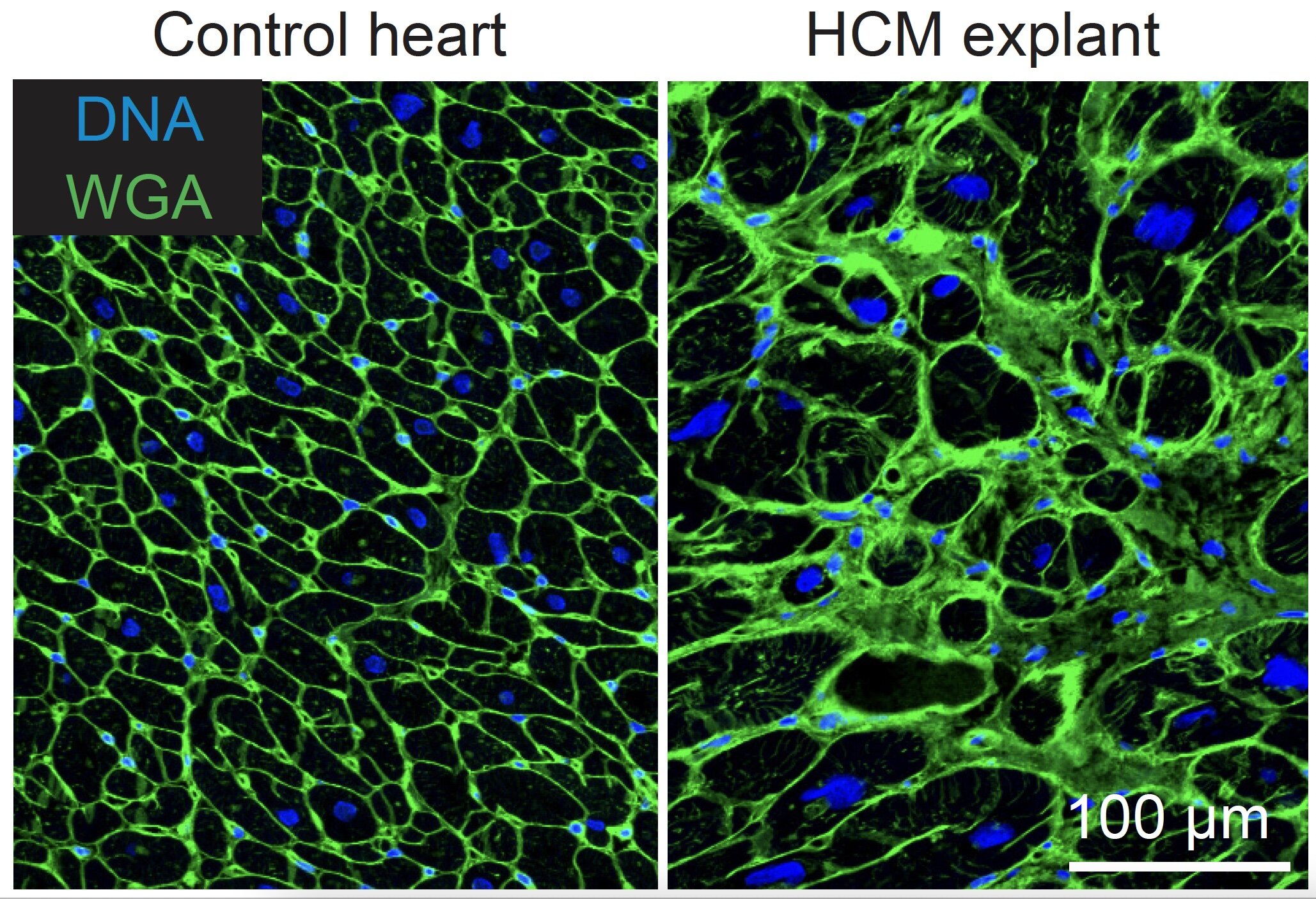 #Single cell RNA sequencing uncovers new mechanisms of heart disease