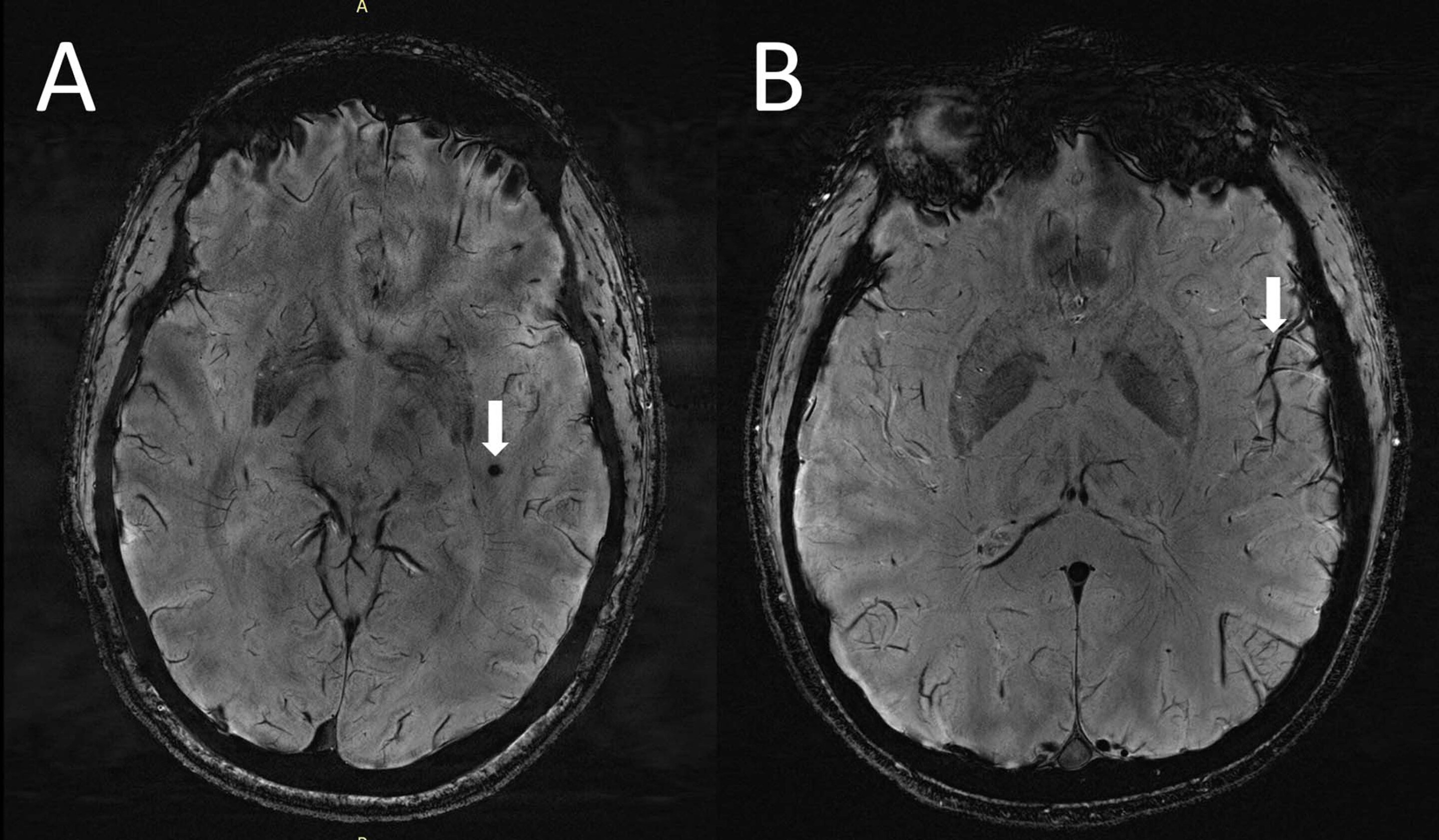Ultra-high-resolution MRI reveals migraine brain changes