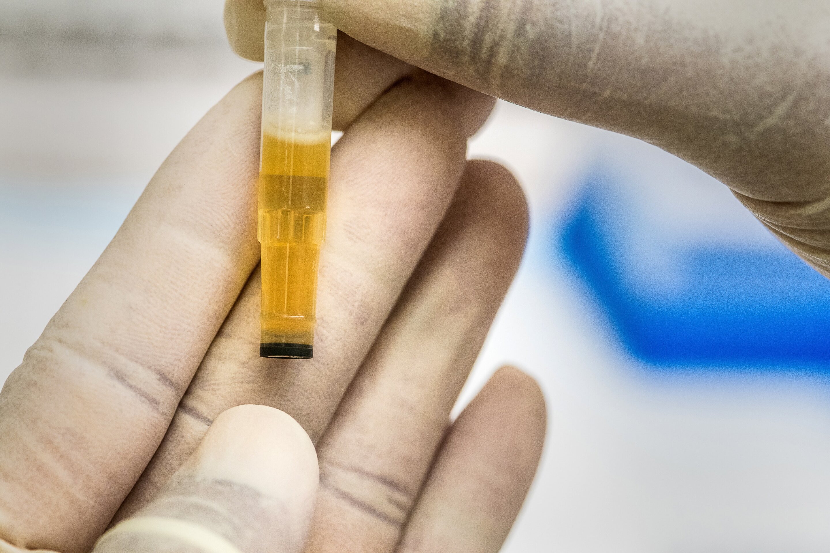 Biomarker in urine could be the first to reveal early-stage Alzheimer’s disease