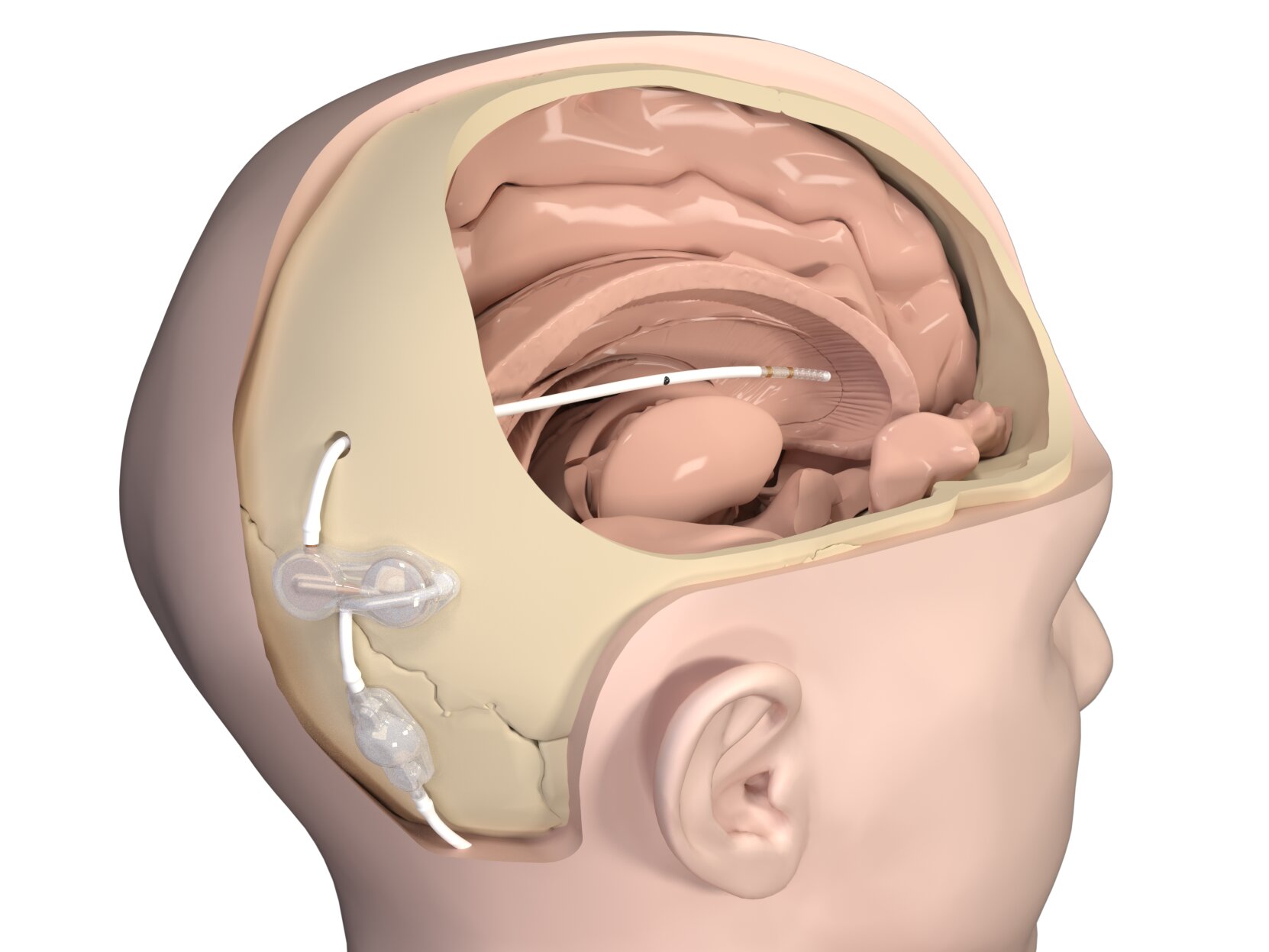 Flushing regimen with simple implant may prevent shunt clogs, reduce  revision surgeries in hydrocephalus patients