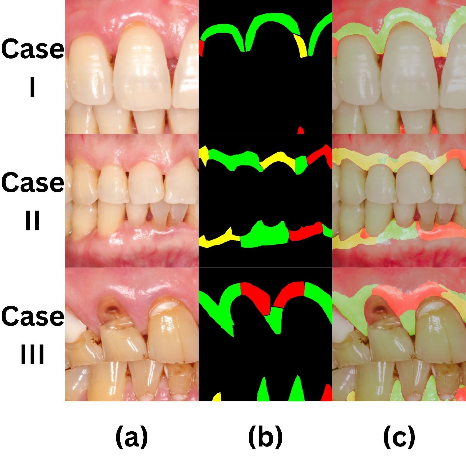 Dentistry crew makes use of synthetic intelligence for early detection of gum irritation