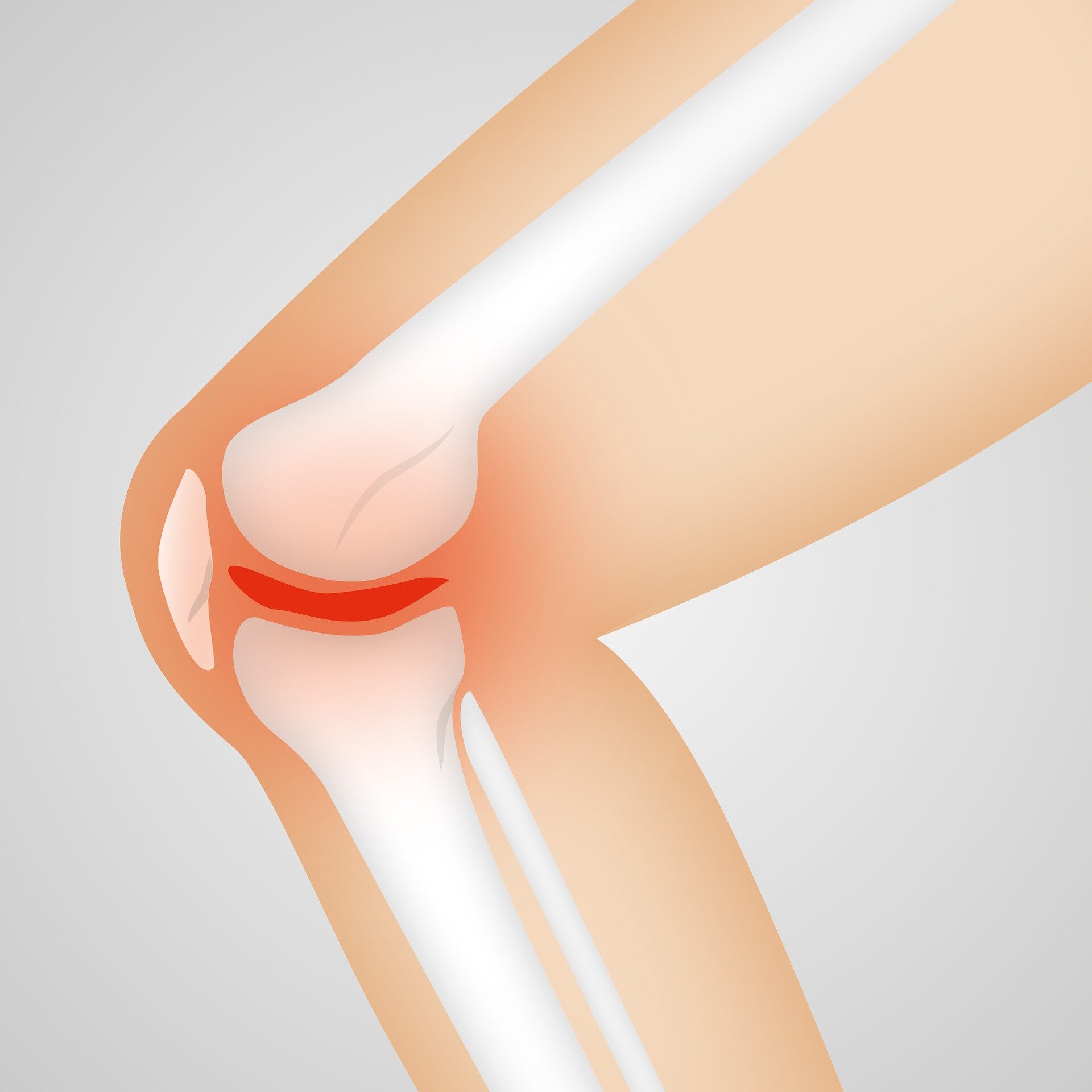 Preventing weight gain can help avoid total knee replacement
