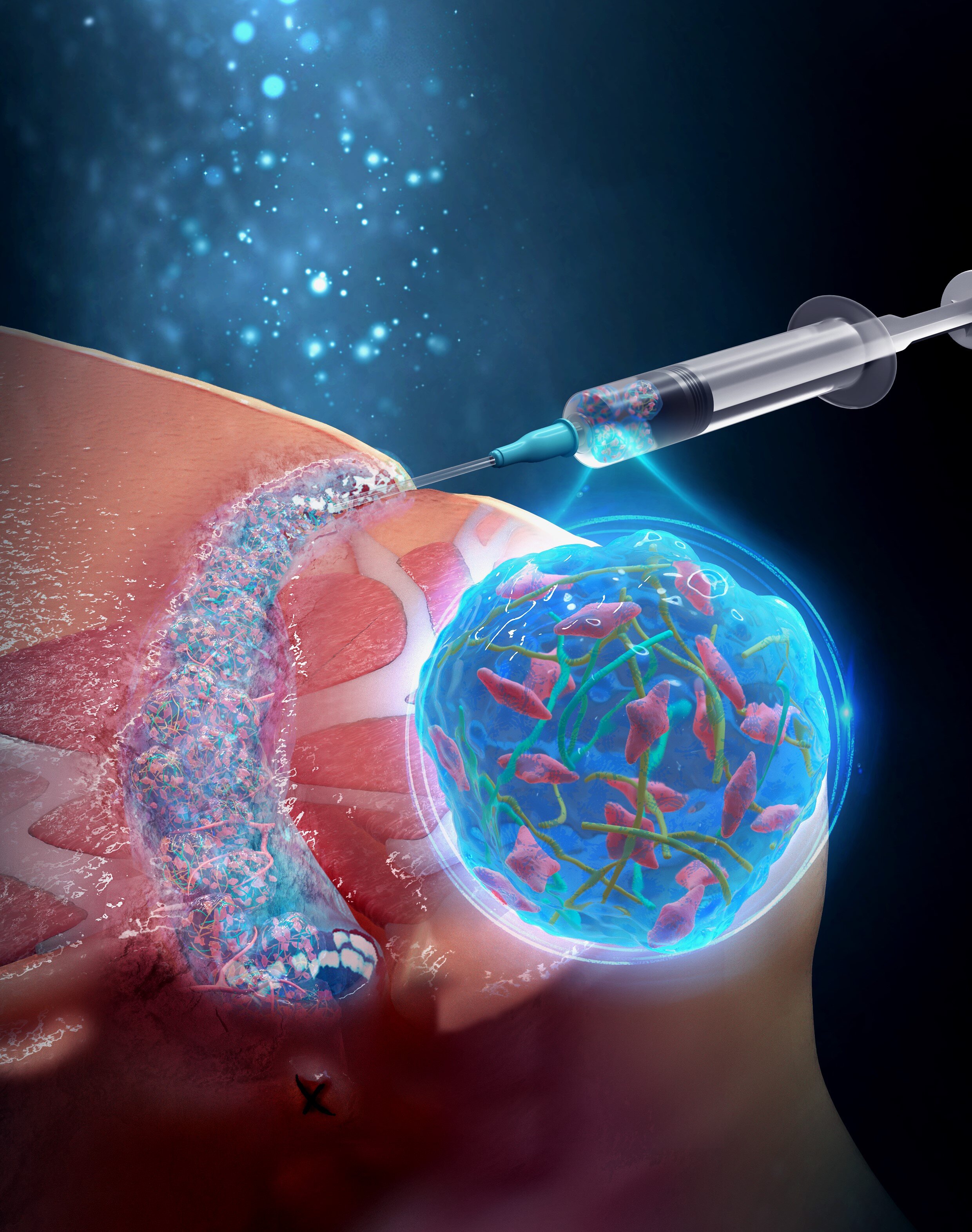 L'idrogel di nanofibre caricato con cellule staminali mostra il successo nel trattamento delle gravi complicanze della malattia di Crohn