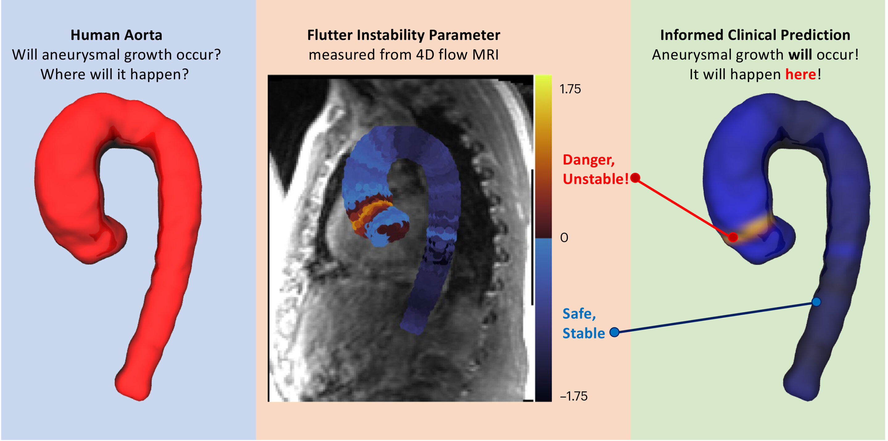 Unstable ‘flutter’ predicts aortic aneurysm with 98% accuracy