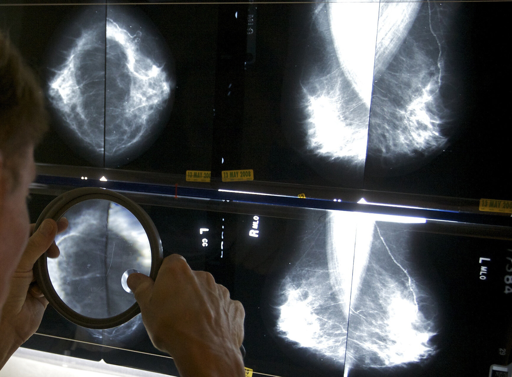 US requires new info on breast density with all mammograms