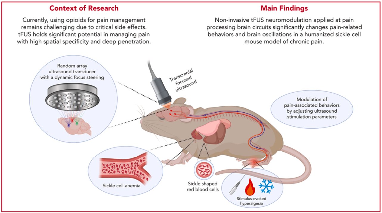 Noninvasive focused ultrasound show potential for combating chronic pain