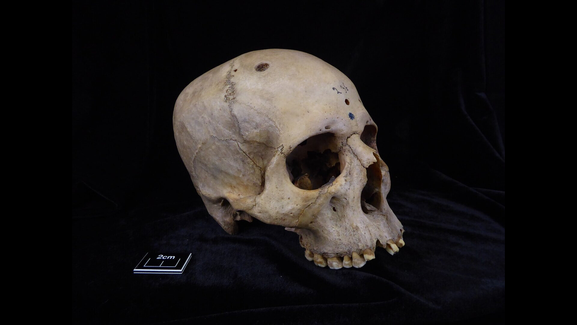 „Výjimečná“ 4000 let stará egyptská lebka může vykazovat známky pokusů o léčbu rakoviny
