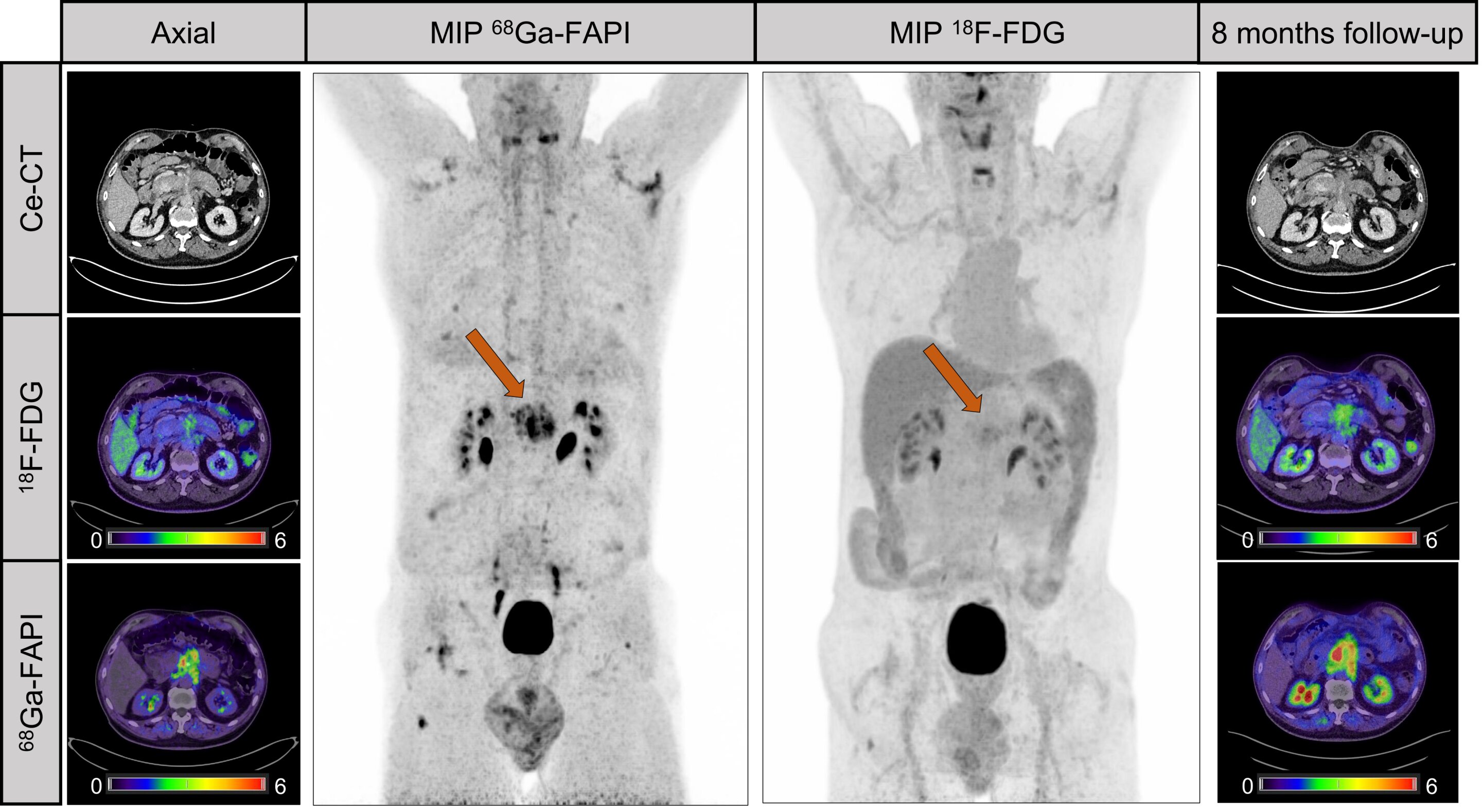 #Ga-68 FAPI PET found to improve detection and staging of pancreatic cancer
