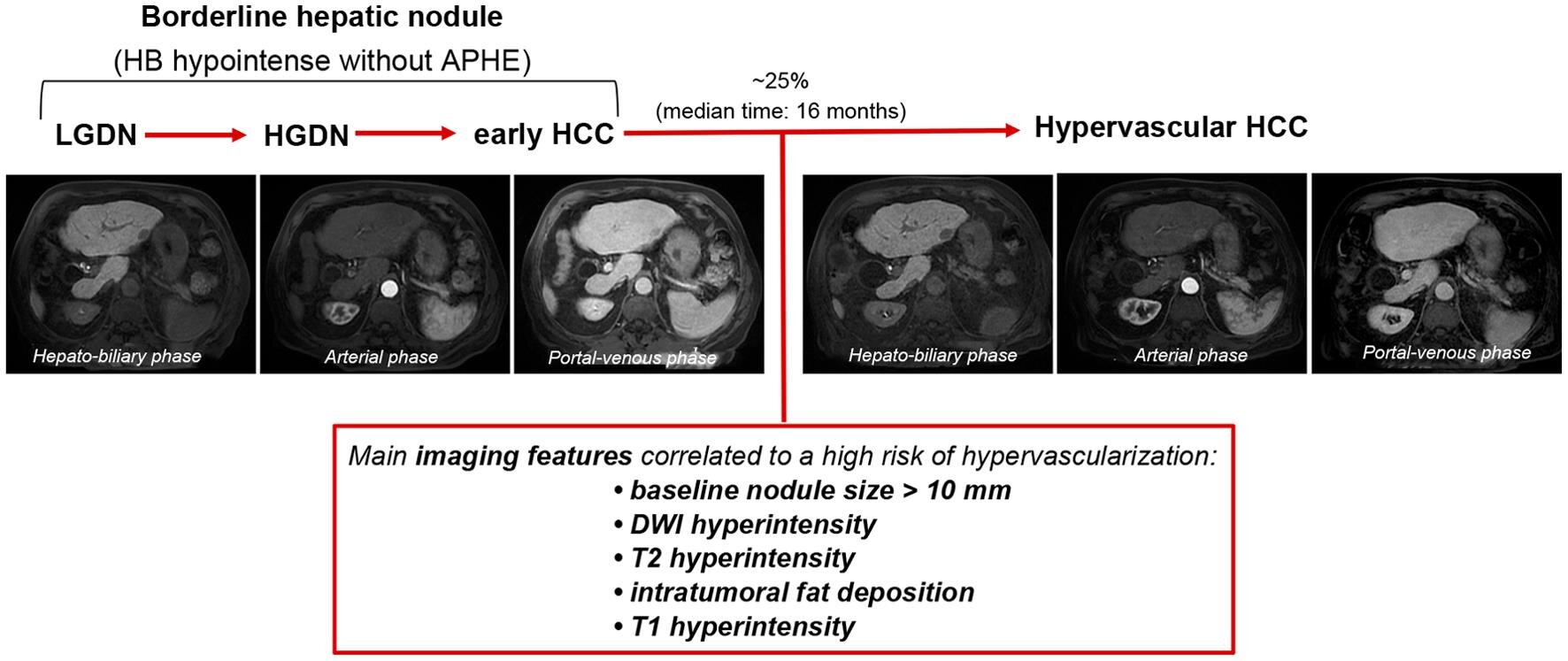 Liver lesions at risk of transformation into hepatocellular carcinoma ...