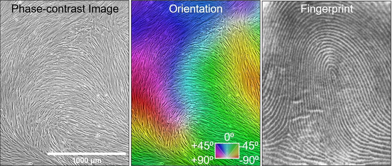 Researchers discover novel method to predict effectiveness of mesenchymal stromal cells for cartilage repair