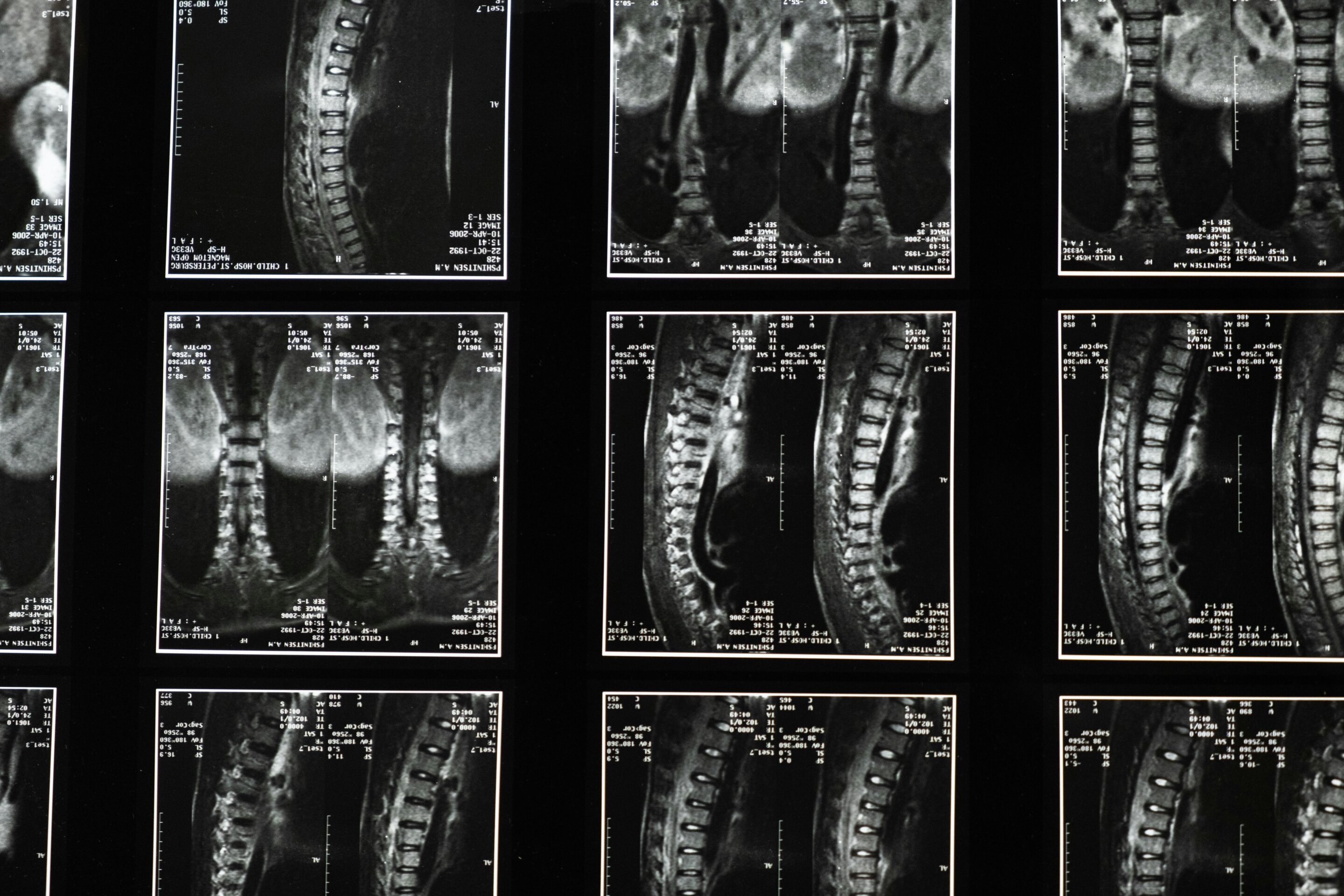 #Arm fat may reveal women and men at risk of spinal fracture