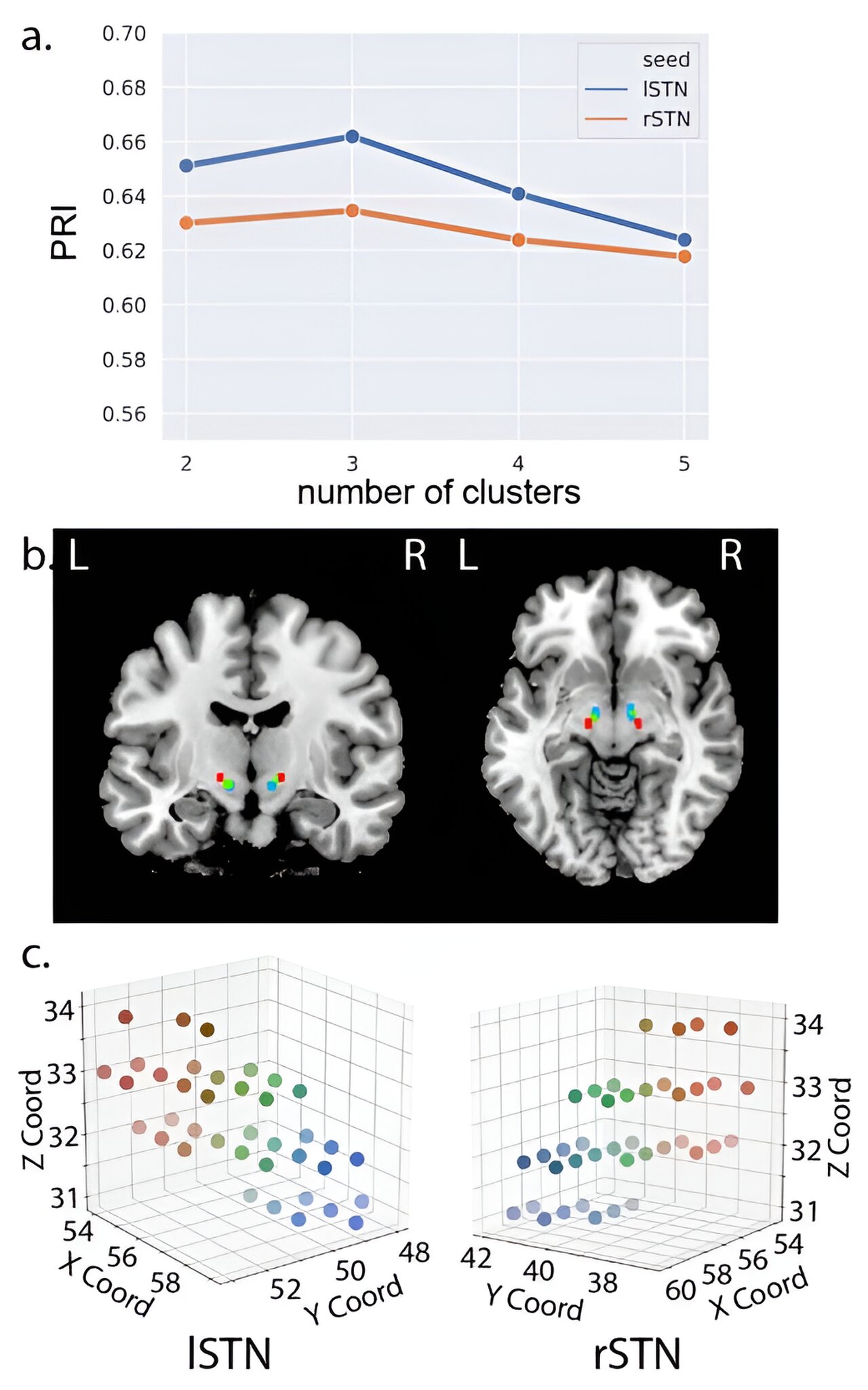 #Study reveals brain mechanisms behind speech impairment in Parkinson’s